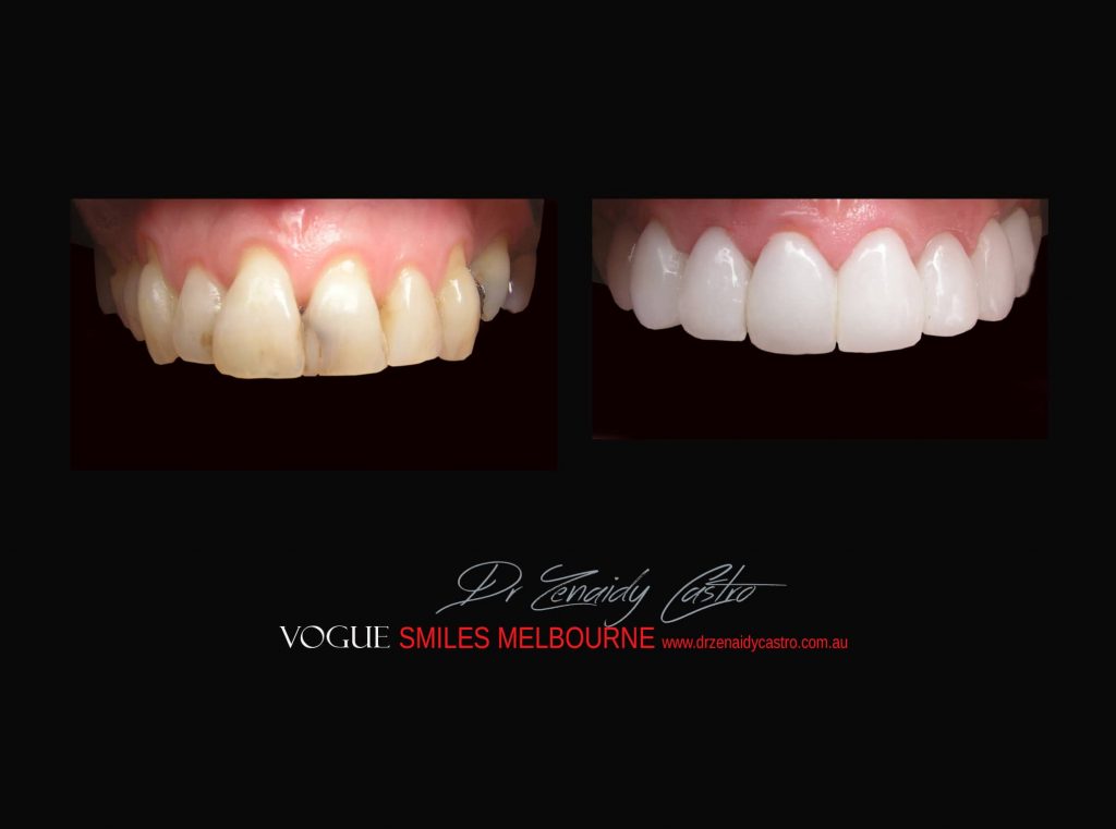 Top Cosmetic Dentist in Melbourne CBD before and after photo case study r72