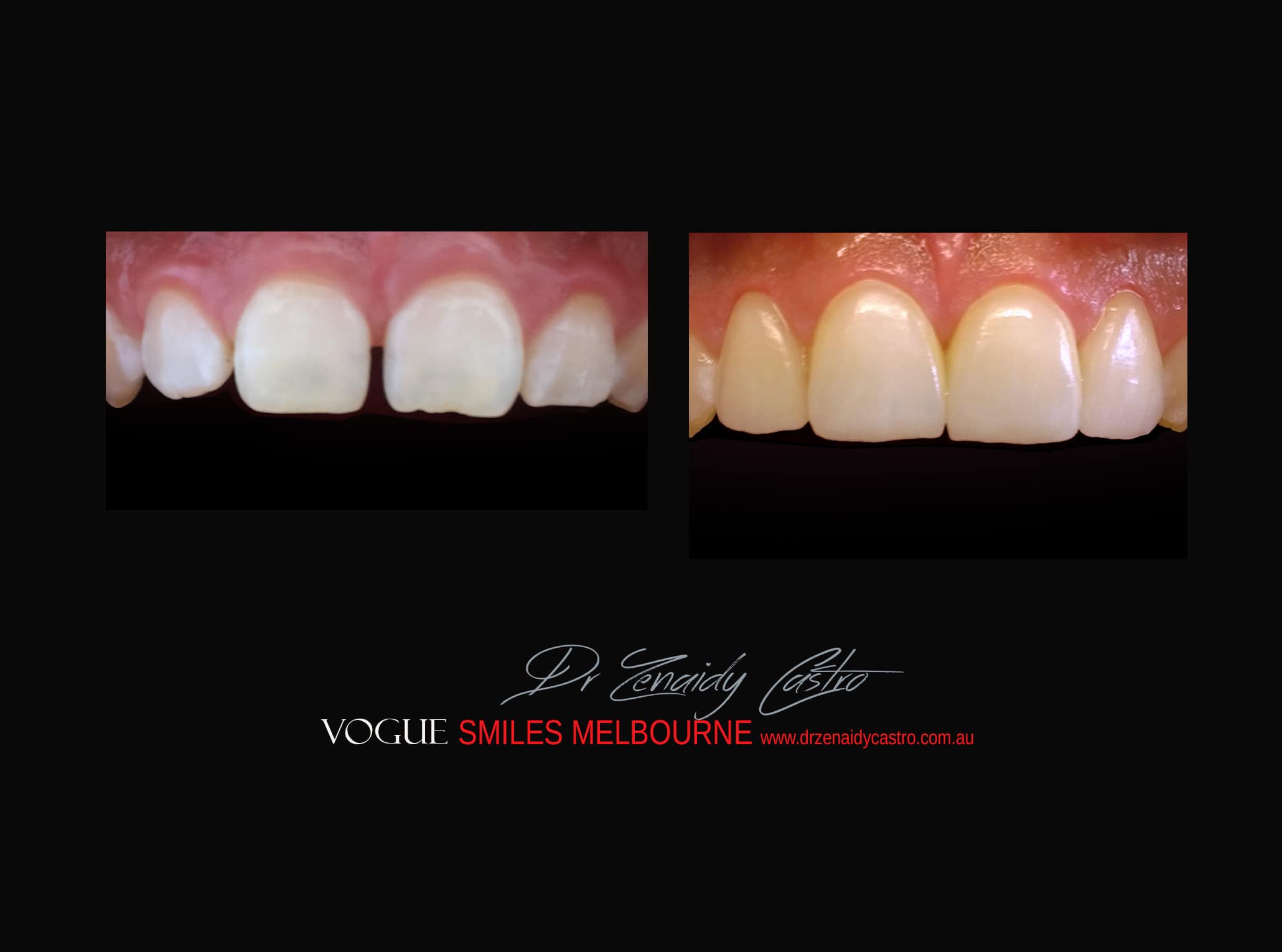Top Cosmetic Dentist in Melbourne CBD before and after photo case study r71