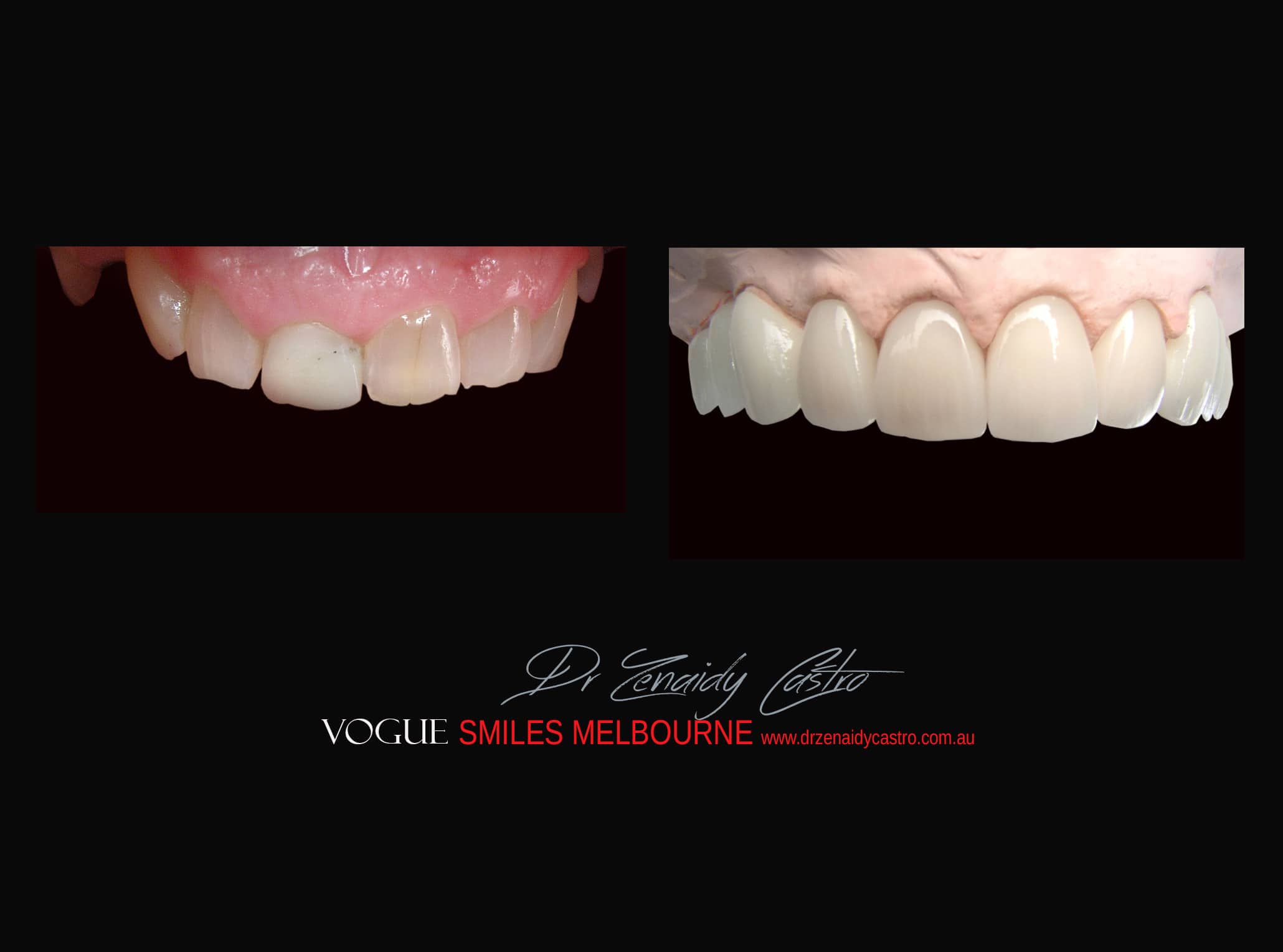 Top Cosmetic Dentist in Melbourne CBD before and after photo case study r70