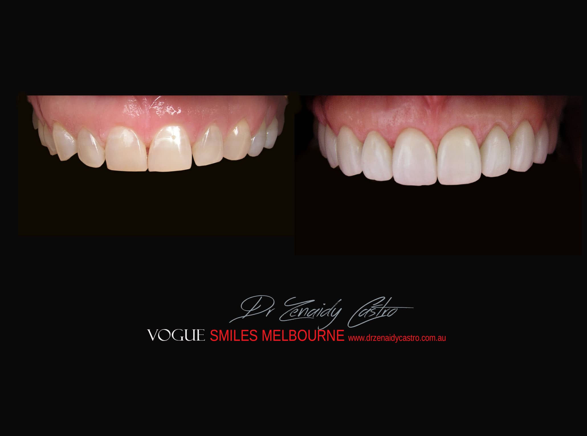 Top Cosmetic Dentist in Melbourne CBD before and after photo case study r69