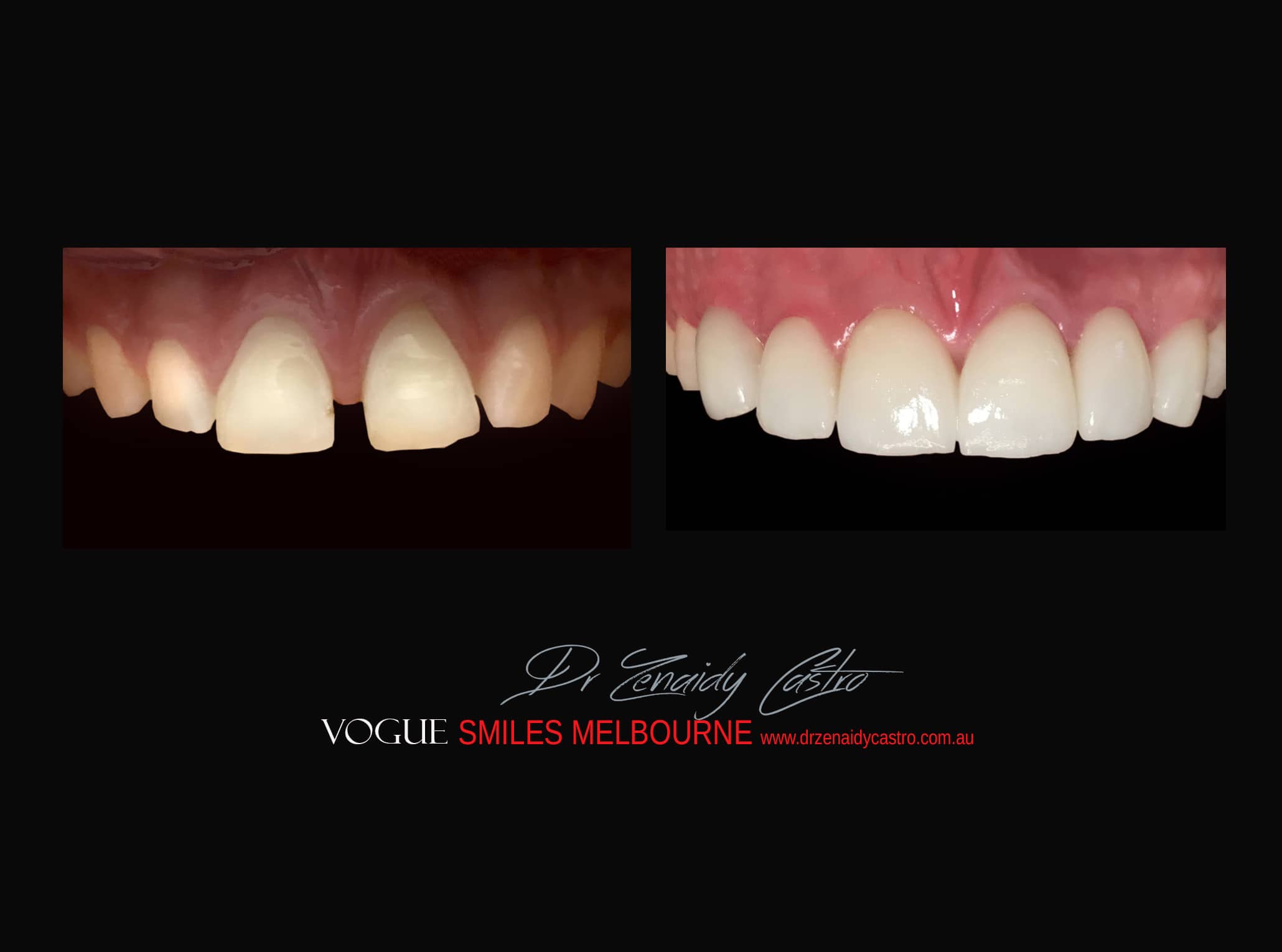 Top Cosmetic Dentist in Melbourne CBD before and after photo case study r68