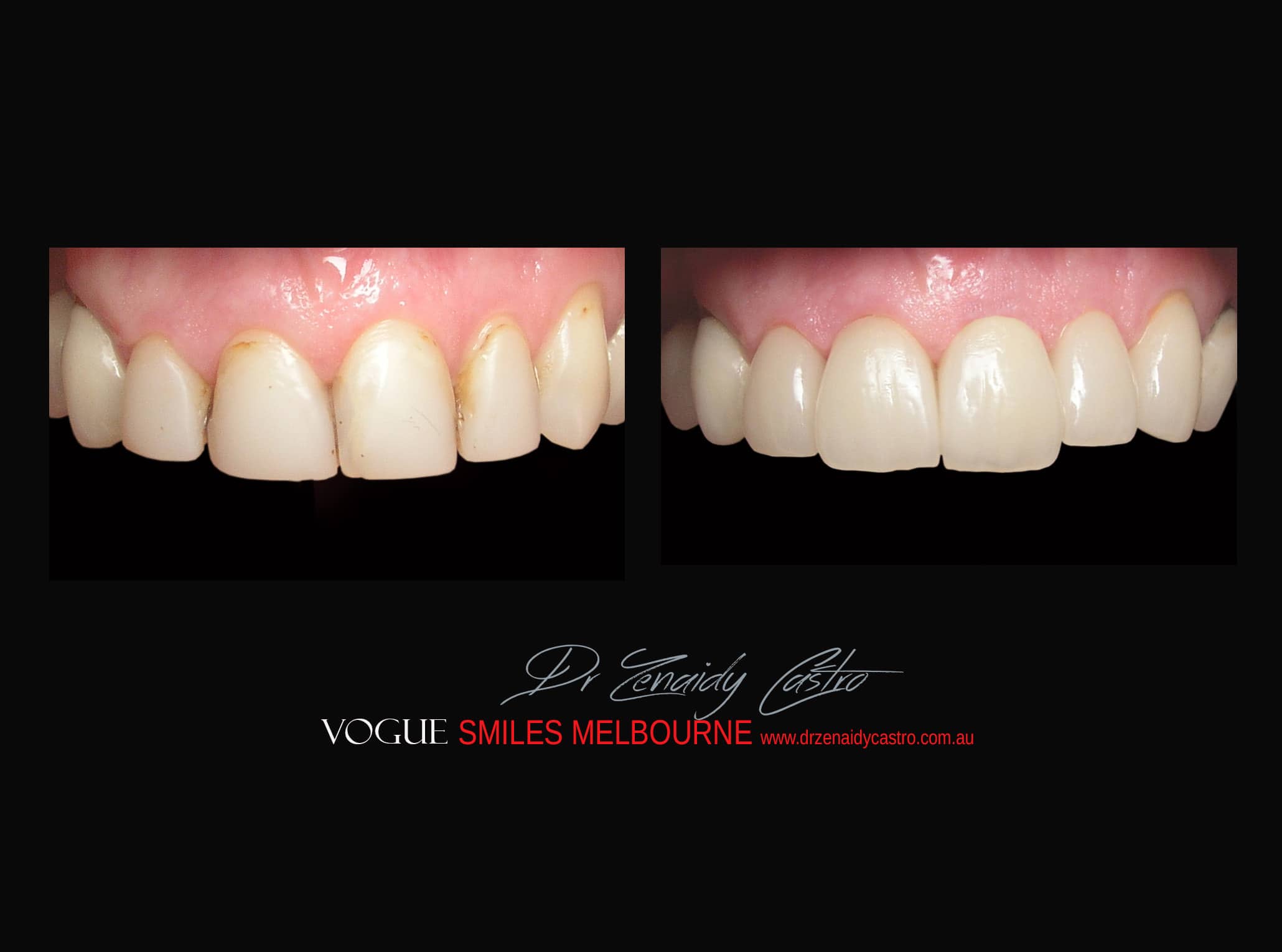 Top Cosmetic Dentist in Melbourne CBD before and after photo case study r67