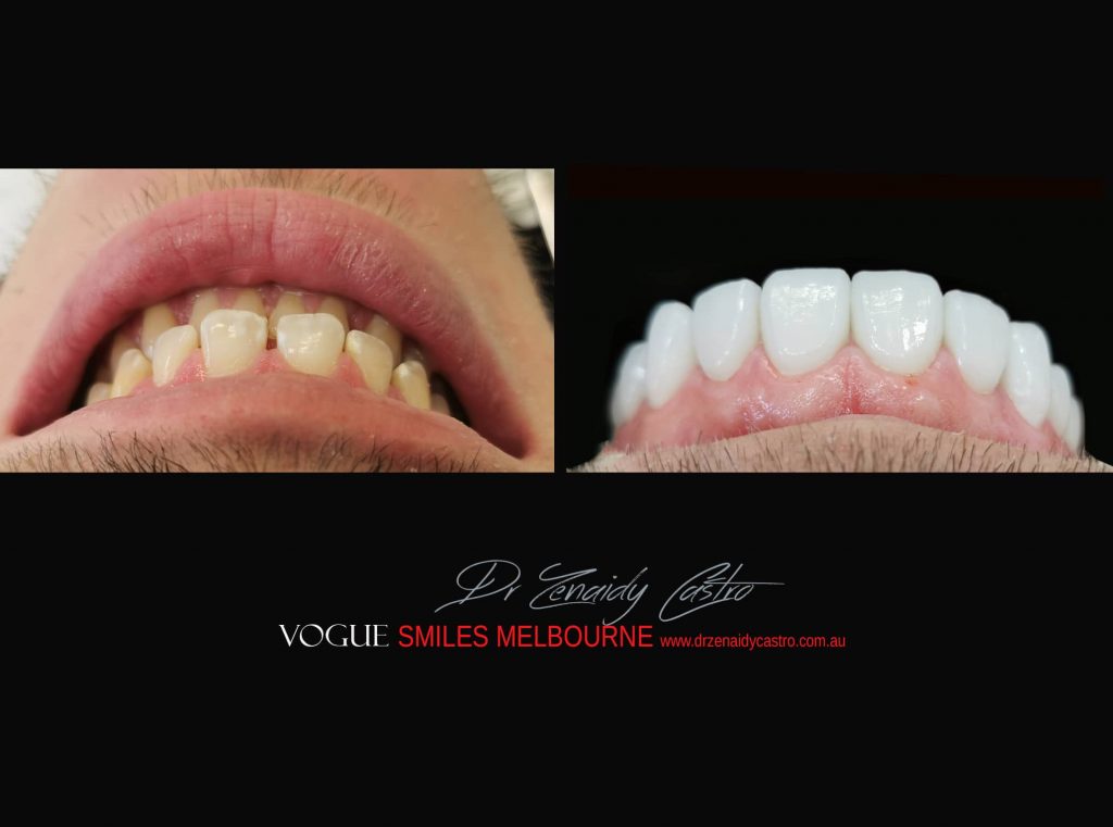 Top Cosmetic Dentist in Melbourne CBD before and after photo case study r66