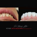 Top Cosmetic Dentist in Melbourne CBD before and after photo case study r66