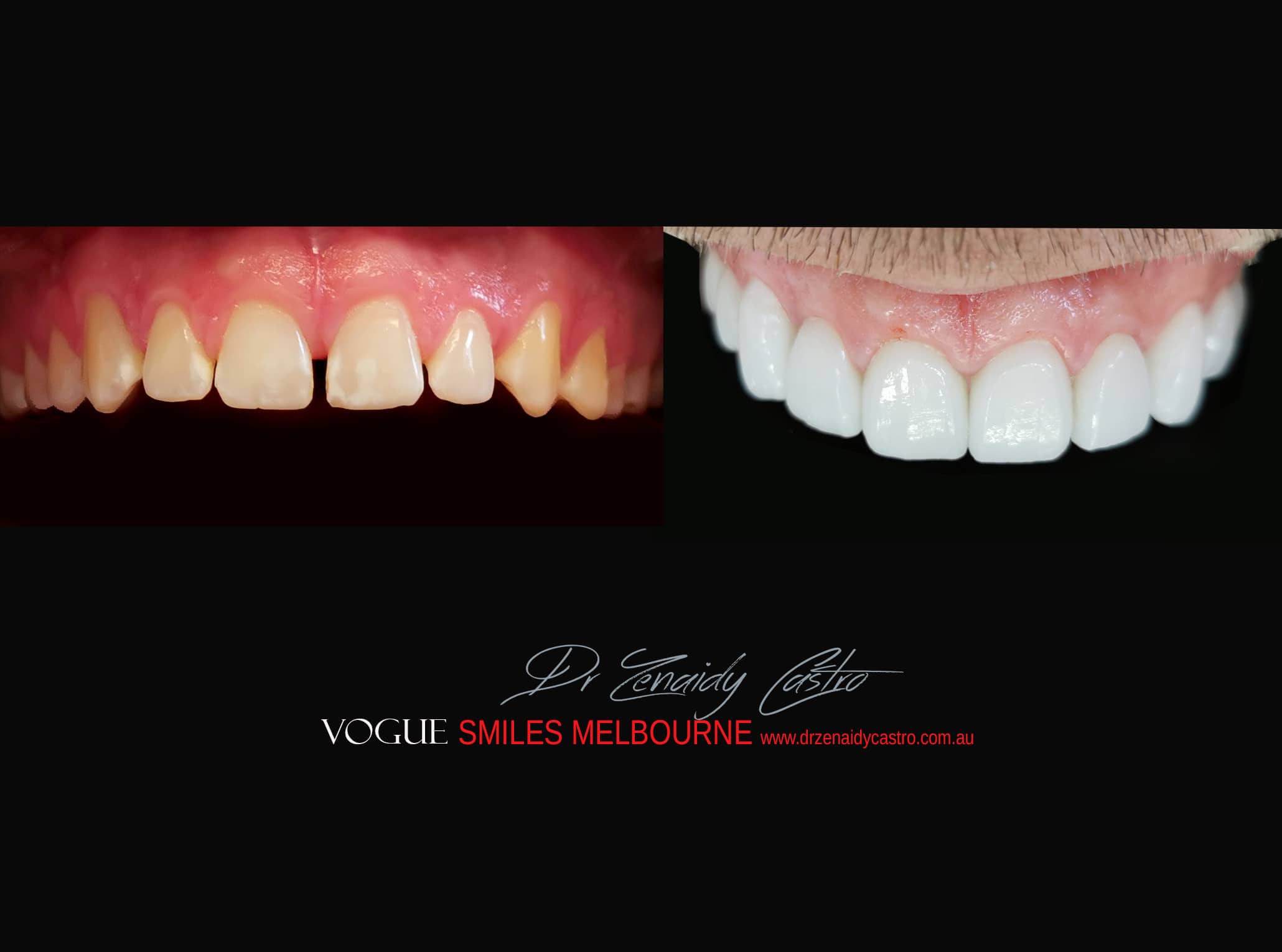 Top Cosmetic Dentist in Melbourne CBD before and after photo case study r65