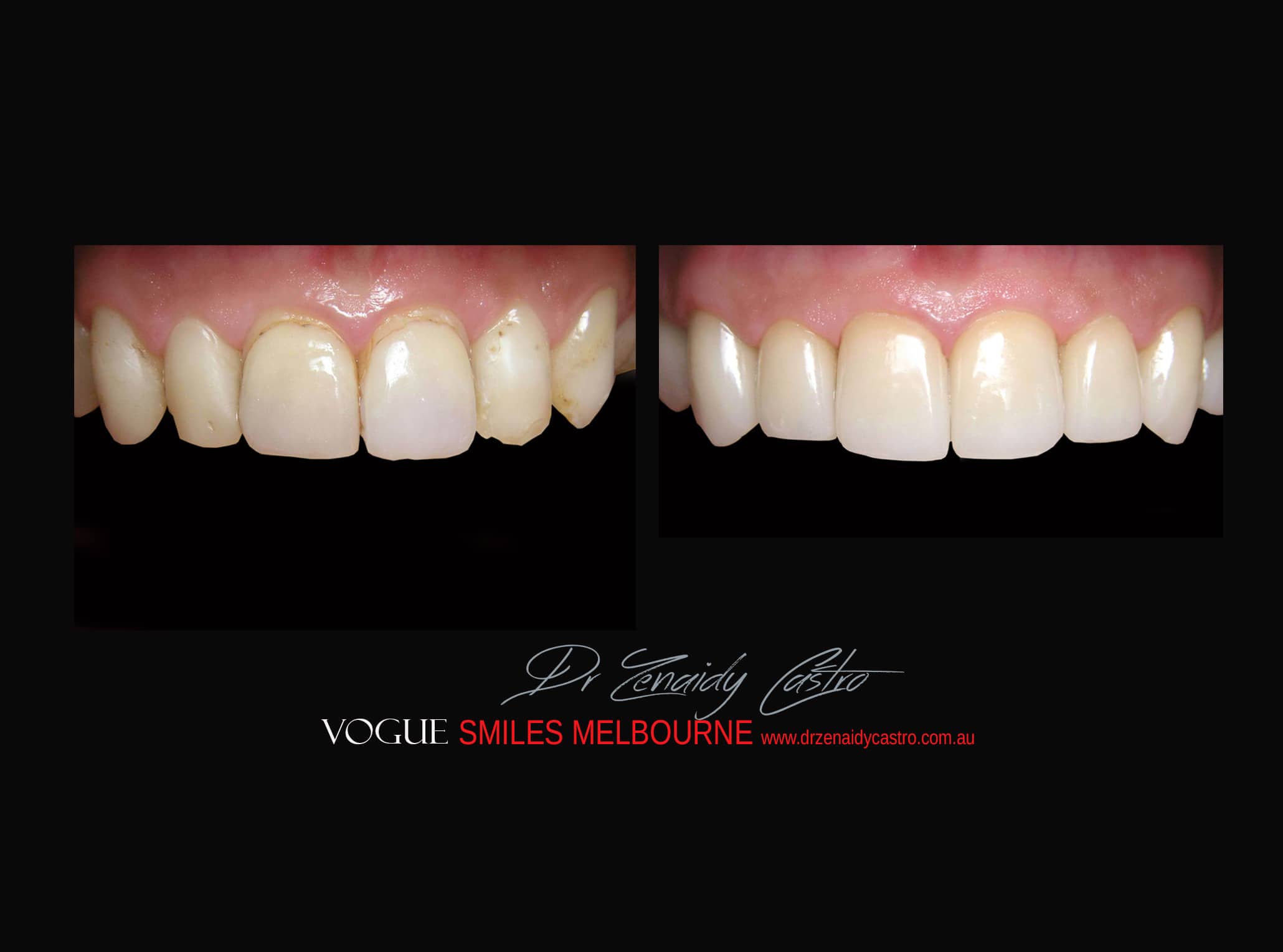 Top Cosmetic Dentist in Melbourne CBD before and after photo case study r64
