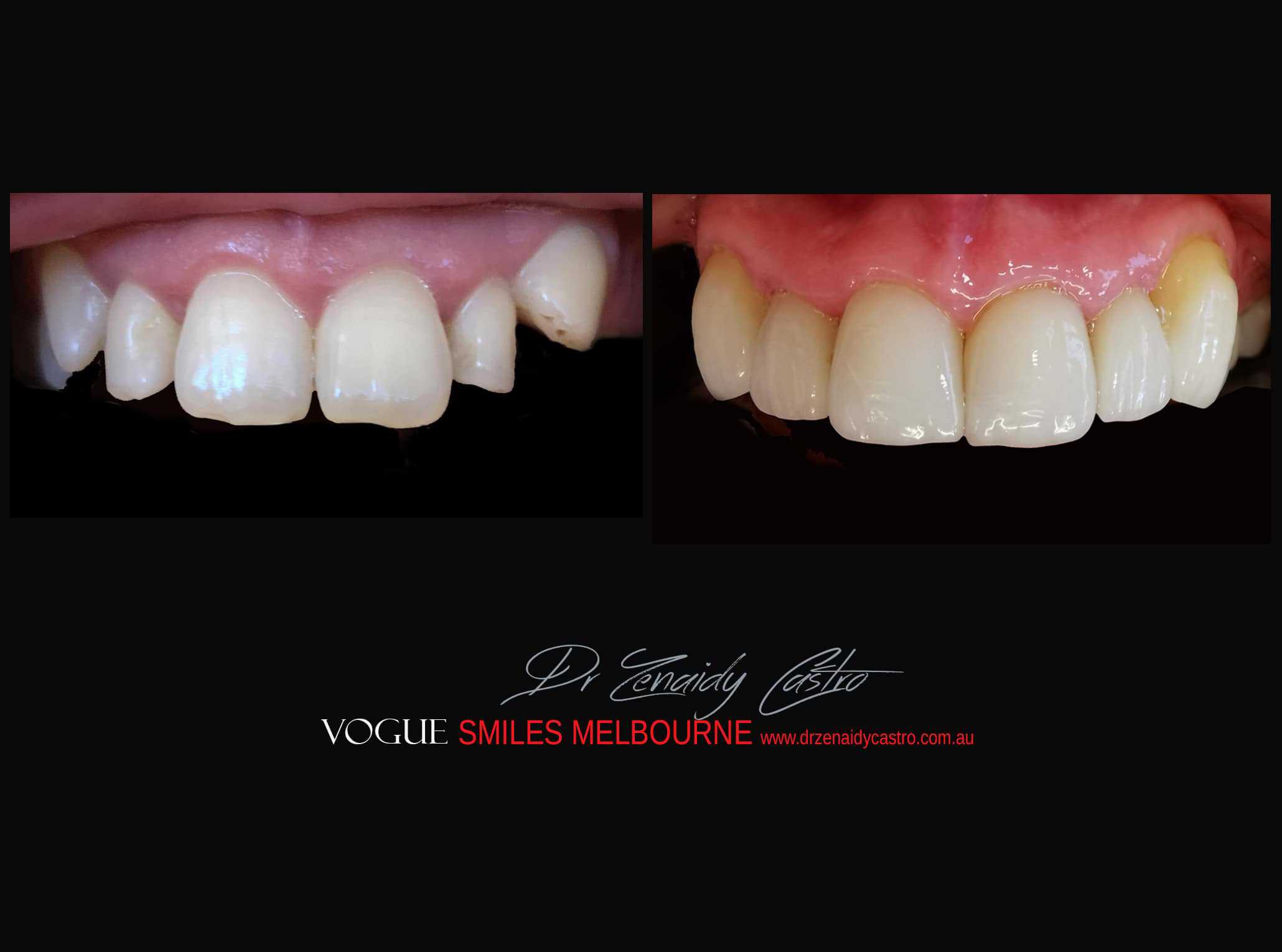 Top Cosmetic Dentist in Melbourne CBD before and after photo case study r81