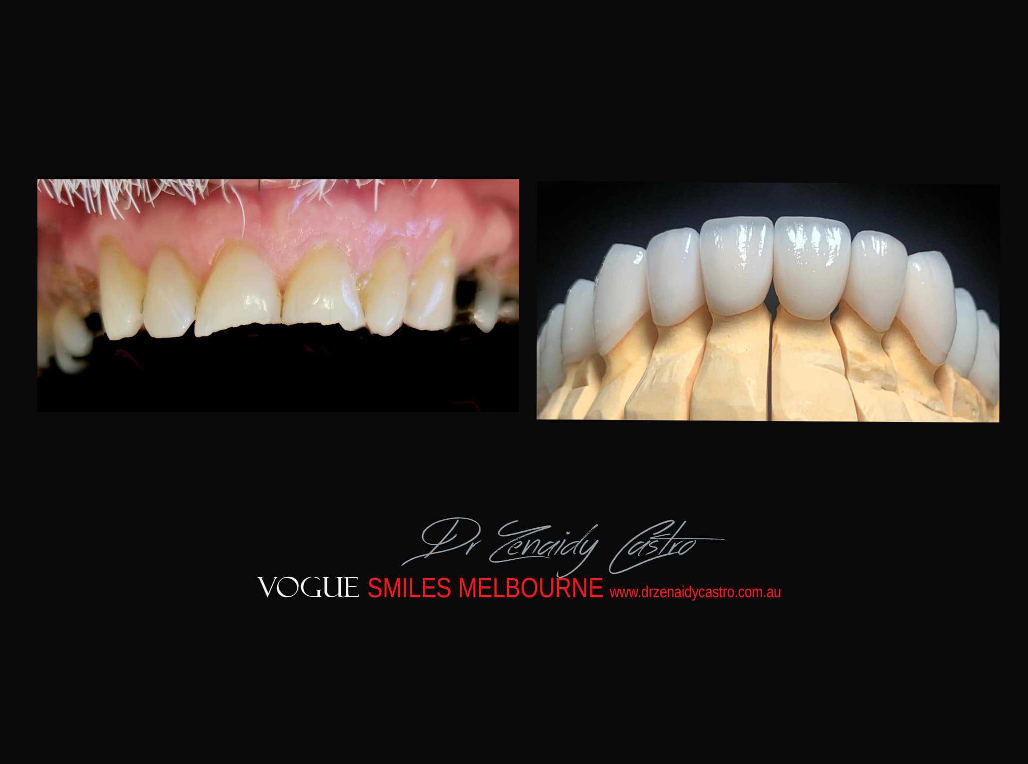Top Cosmetic Dentist in Melbourne CBD before and after photo case study r63