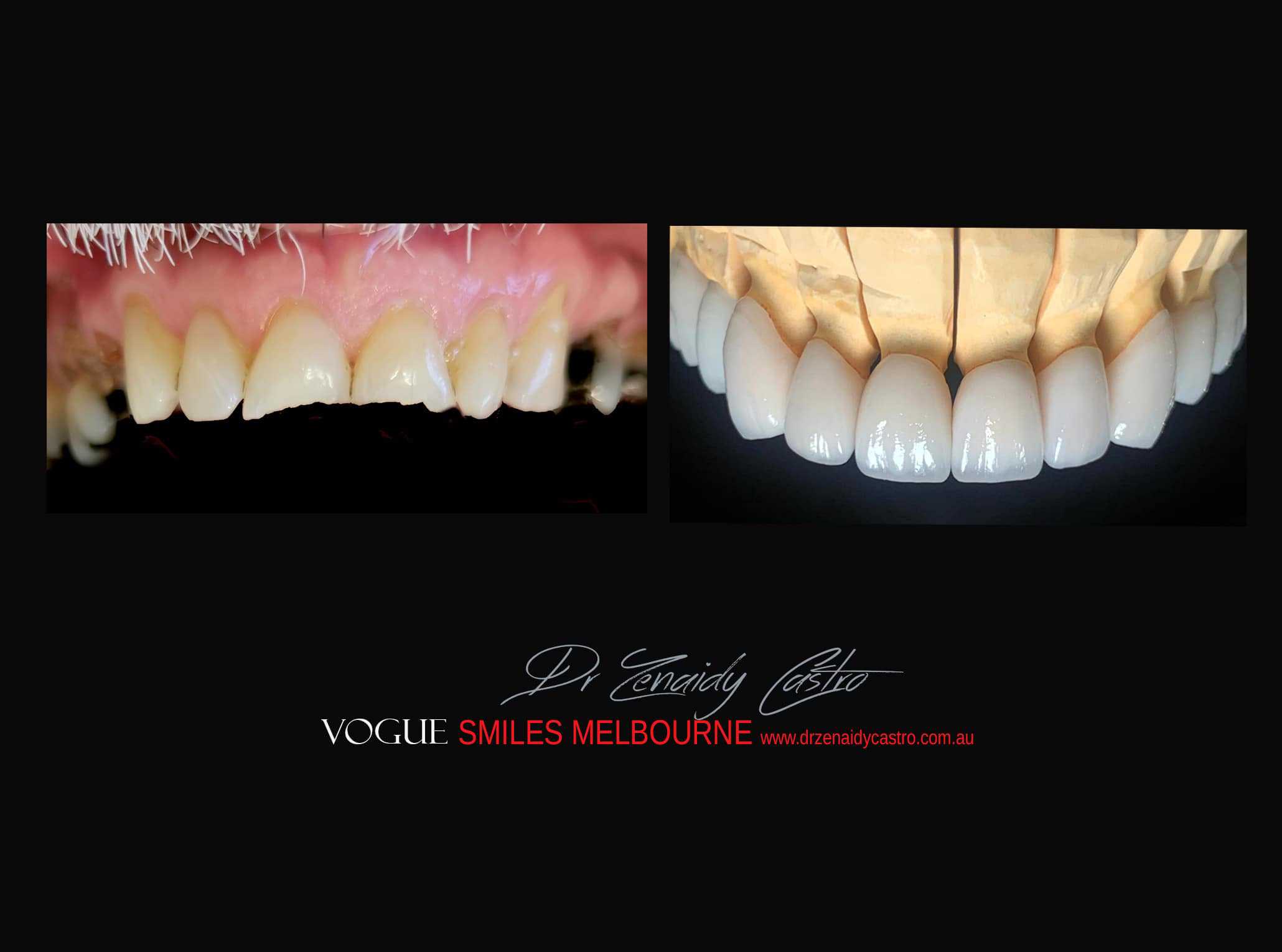 Top Cosmetic Dentist in Melbourne CBD before and after photo case study r62
