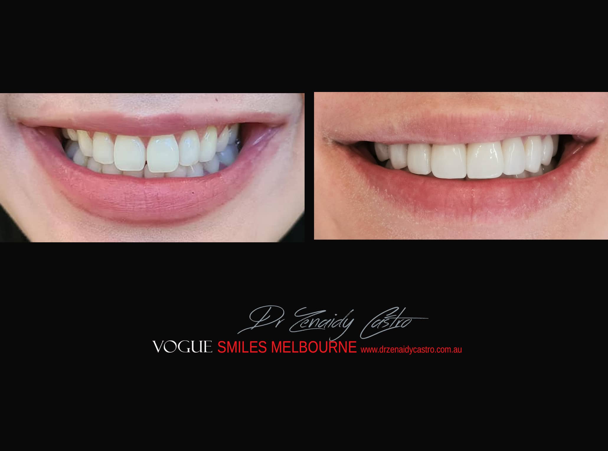 Top Cosmetic Dentist in Melbourne CBD before and after photo case study r61