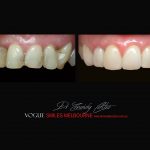 Top Cosmetic Dentist in Melbourne CBD before and after photo case study r60