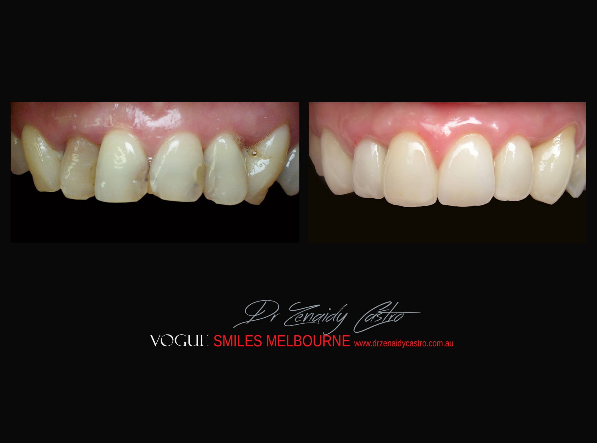 Top Cosmetic Dentist in Melbourne CBD before and after photo case study r60