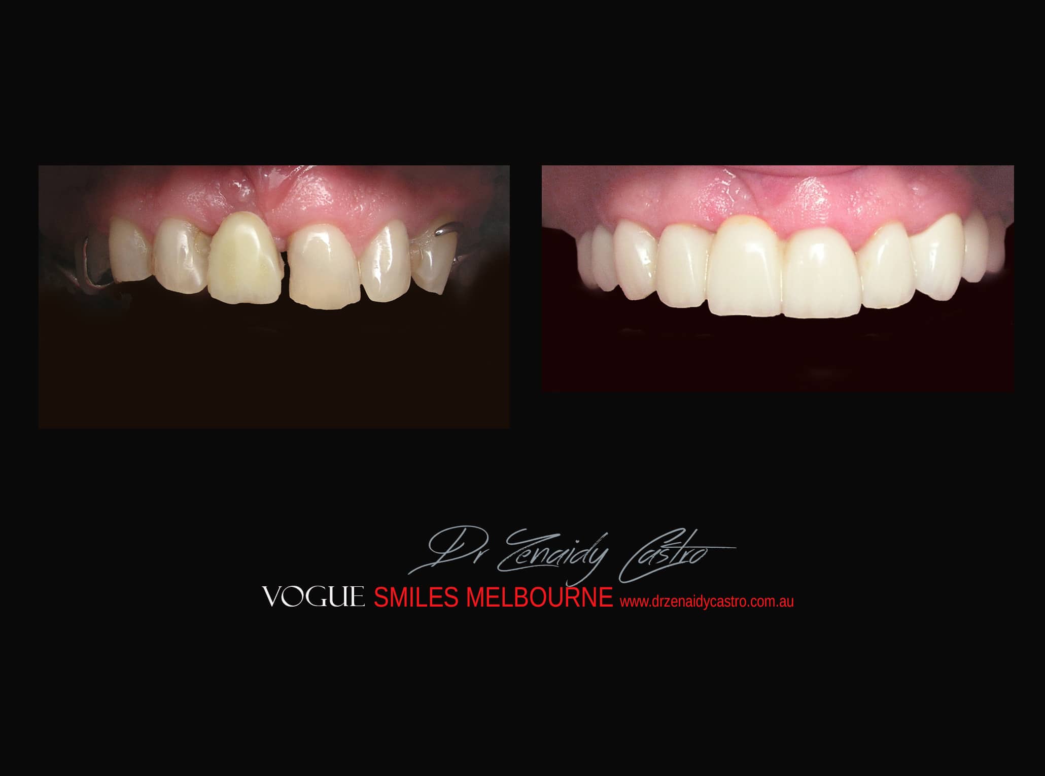 Top Cosmetic Dentist in Melbourne CBD before and after photo case study r58