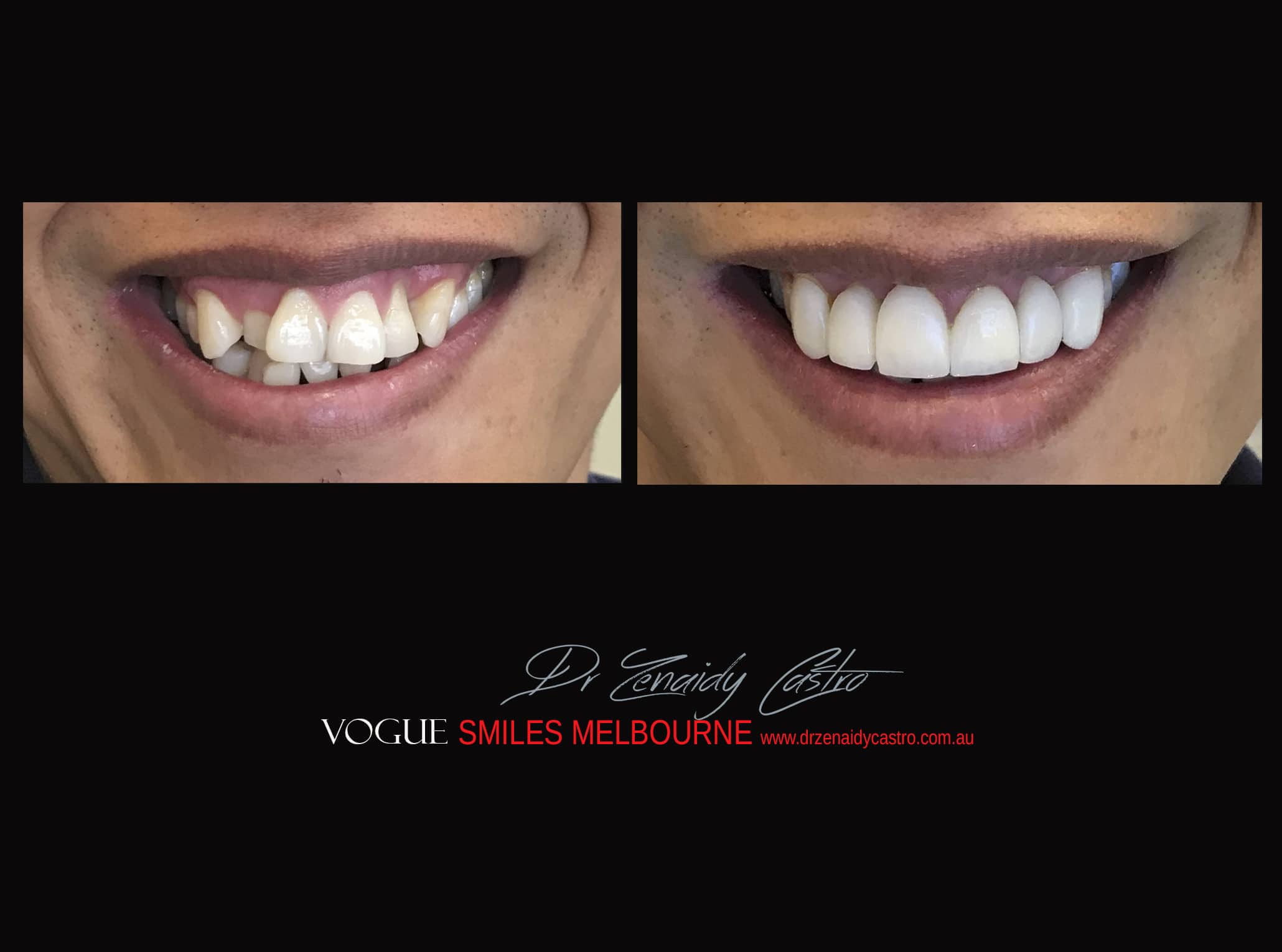 Top Cosmetic Dentist in Melbourne CBD before and after photo case study r57