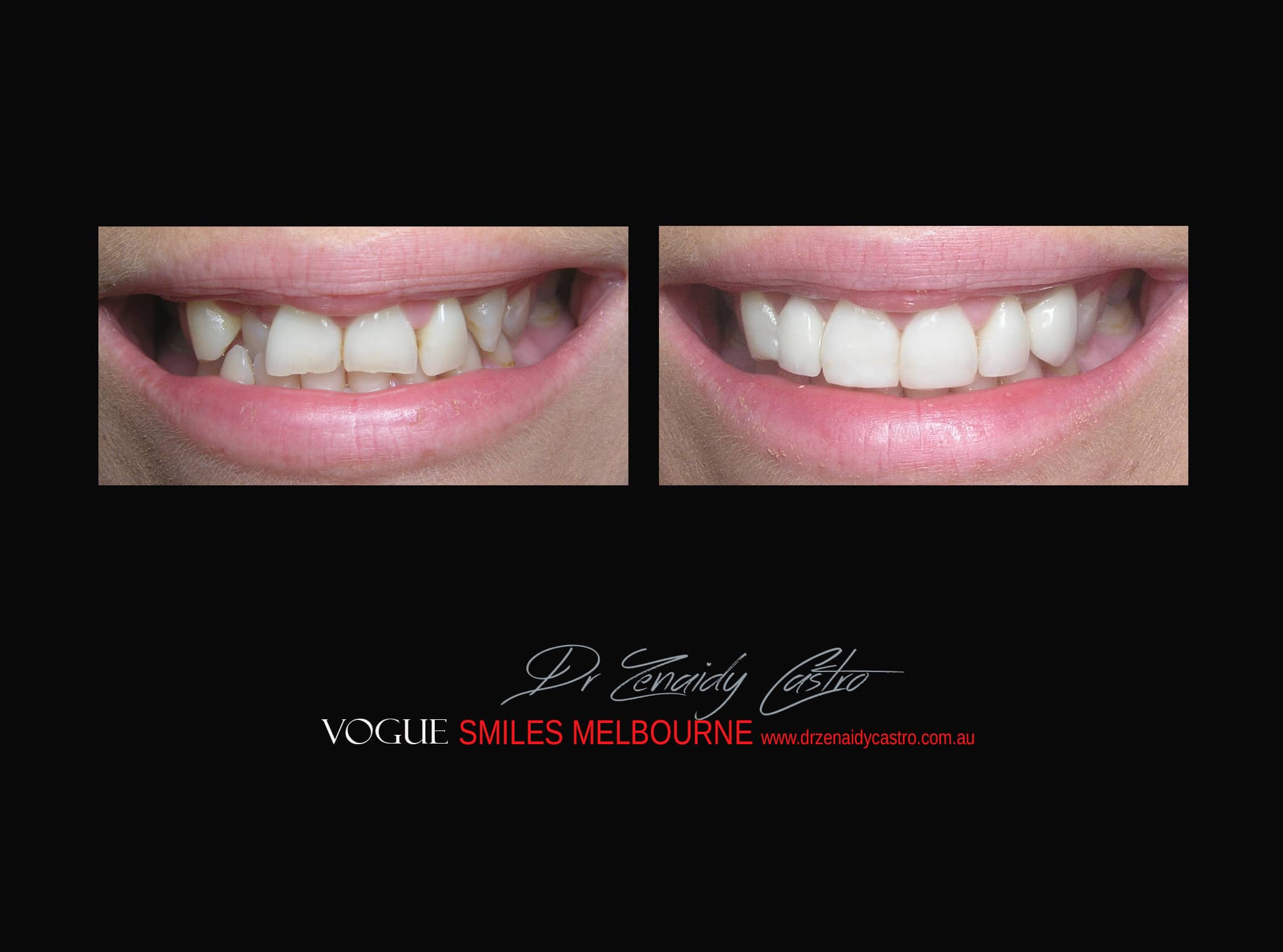 Top Cosmetic Dentist in Melbourne CBD before and after photo case study r56