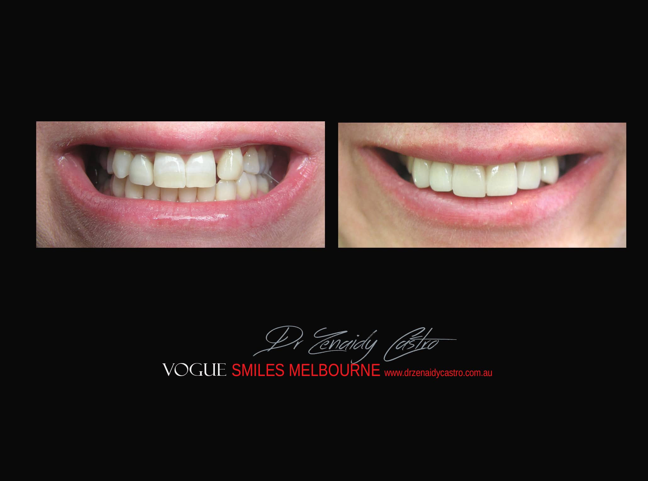 Top Cosmetic Dentist in Melbourne CBD before and after photo case study r55