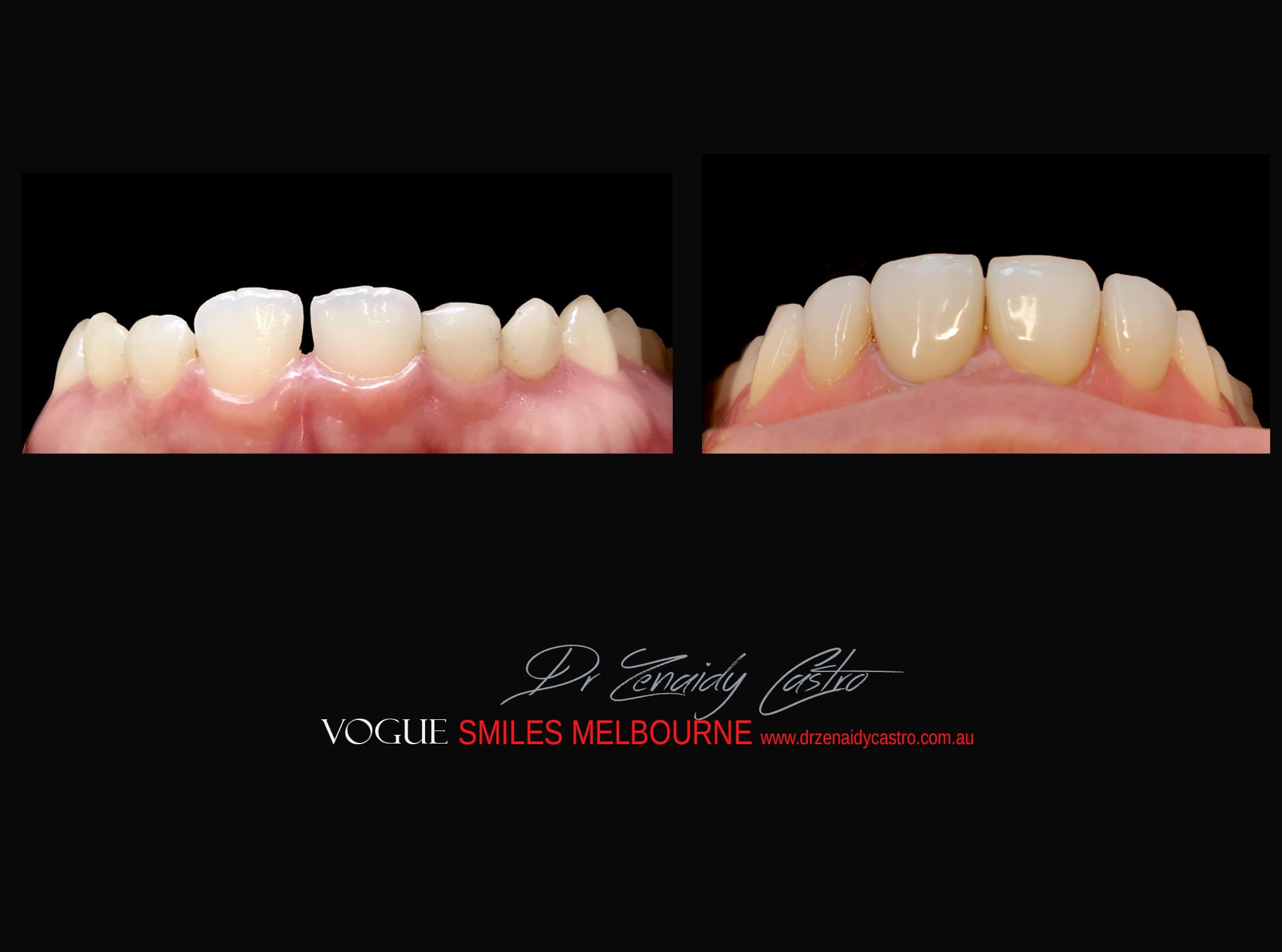 Top Cosmetic Dentist in Melbourne CBD before and after photo case study r54
