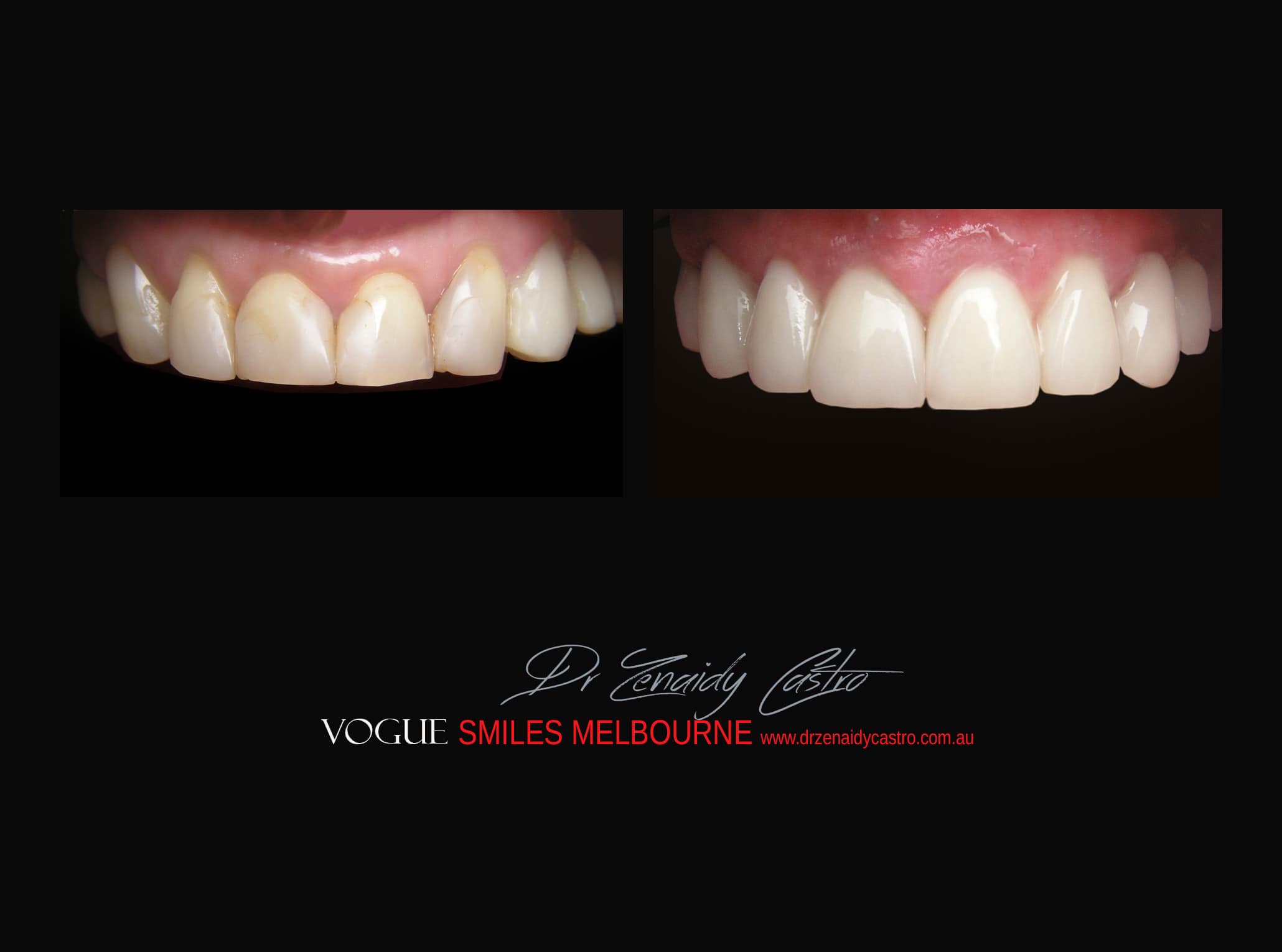 Top Cosmetic Dentist in Melbourne CBD before and after photo case study r80