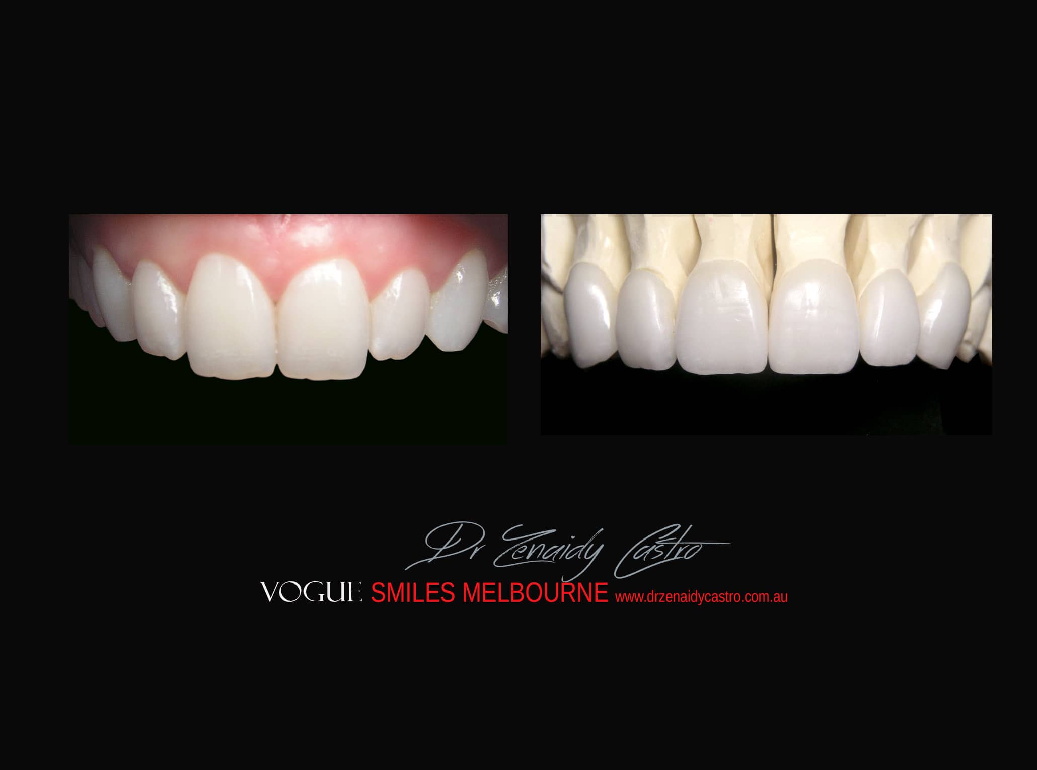 Top Cosmetic Dentist in Melbourne CBD before and after photo case study r53