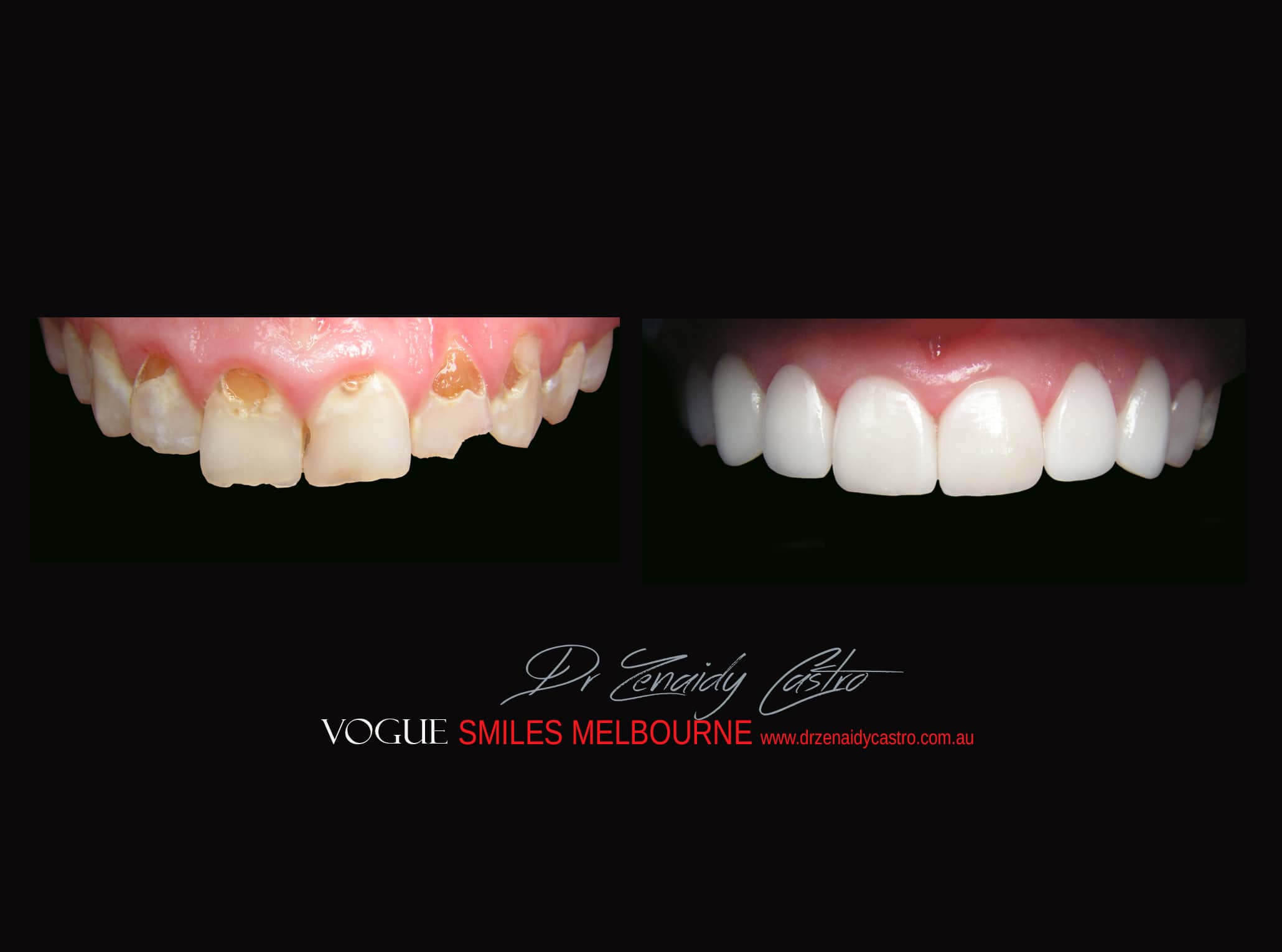 Top Cosmetic Dentist in Melbourne CBD before and after photo case study r52