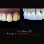 Top Cosmetic Dentist in Melbourne CBD before and after photo case study r51