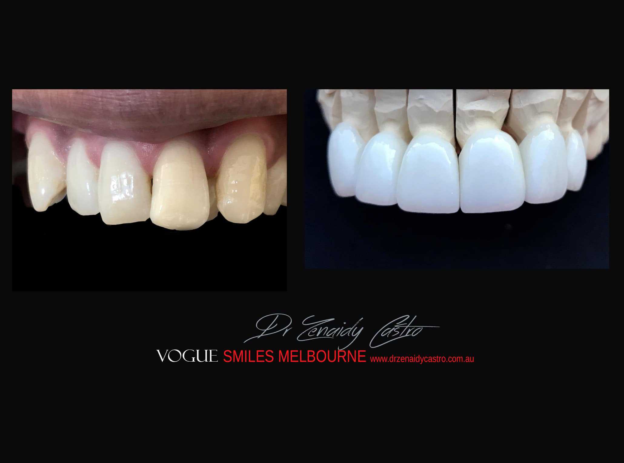 Top Cosmetic Dentist in Melbourne CBD before and after photo case study r51