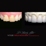 Top Cosmetic Dentist in Melbourne CBD before and after photo case study r50