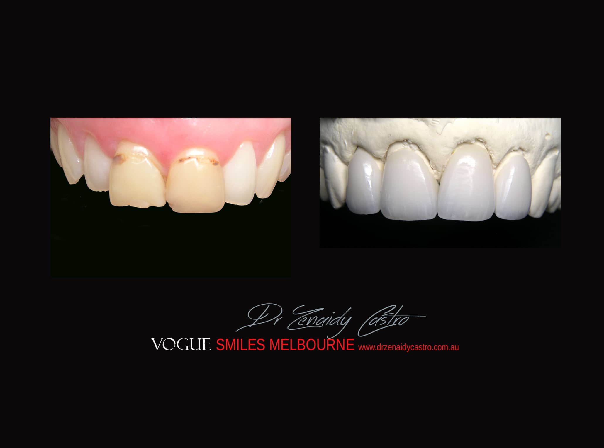 Top Cosmetic Dentist in Melbourne CBD before and after photo case study r50