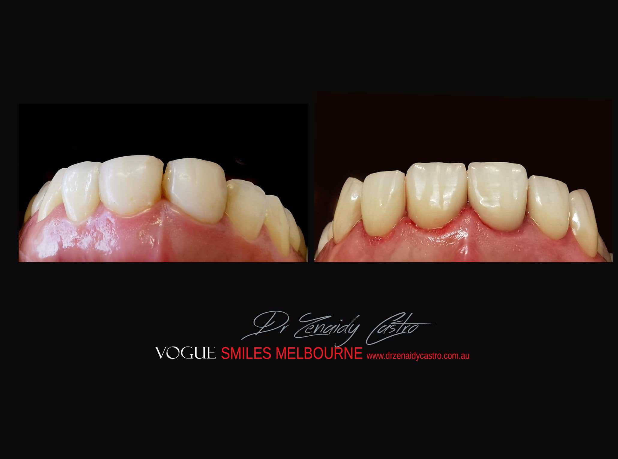 Top Cosmetic Dentist in Melbourne CBD before and after photo case study r49