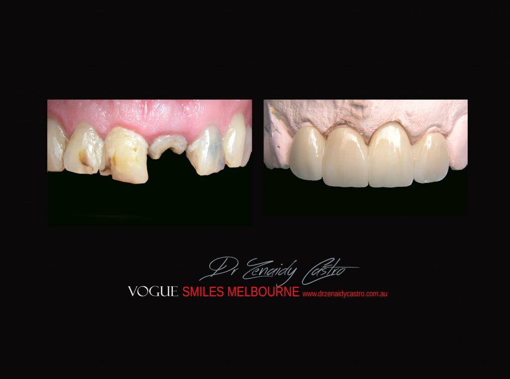Top Cosmetic Dentist in Melbourne CBD before and after photo case study r48