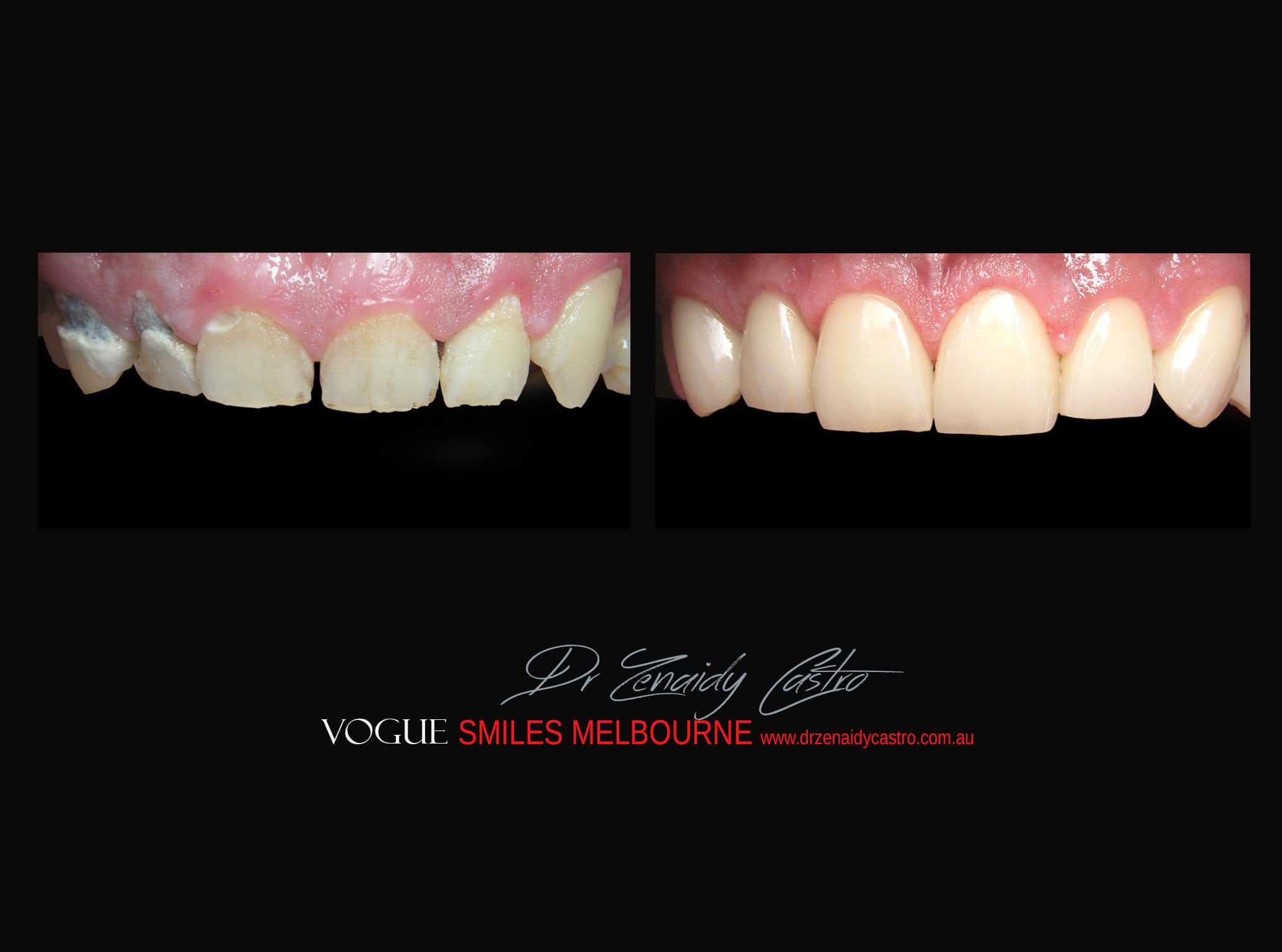 Top Cosmetic Dentist in Melbourne CBD before and after photo case study r47