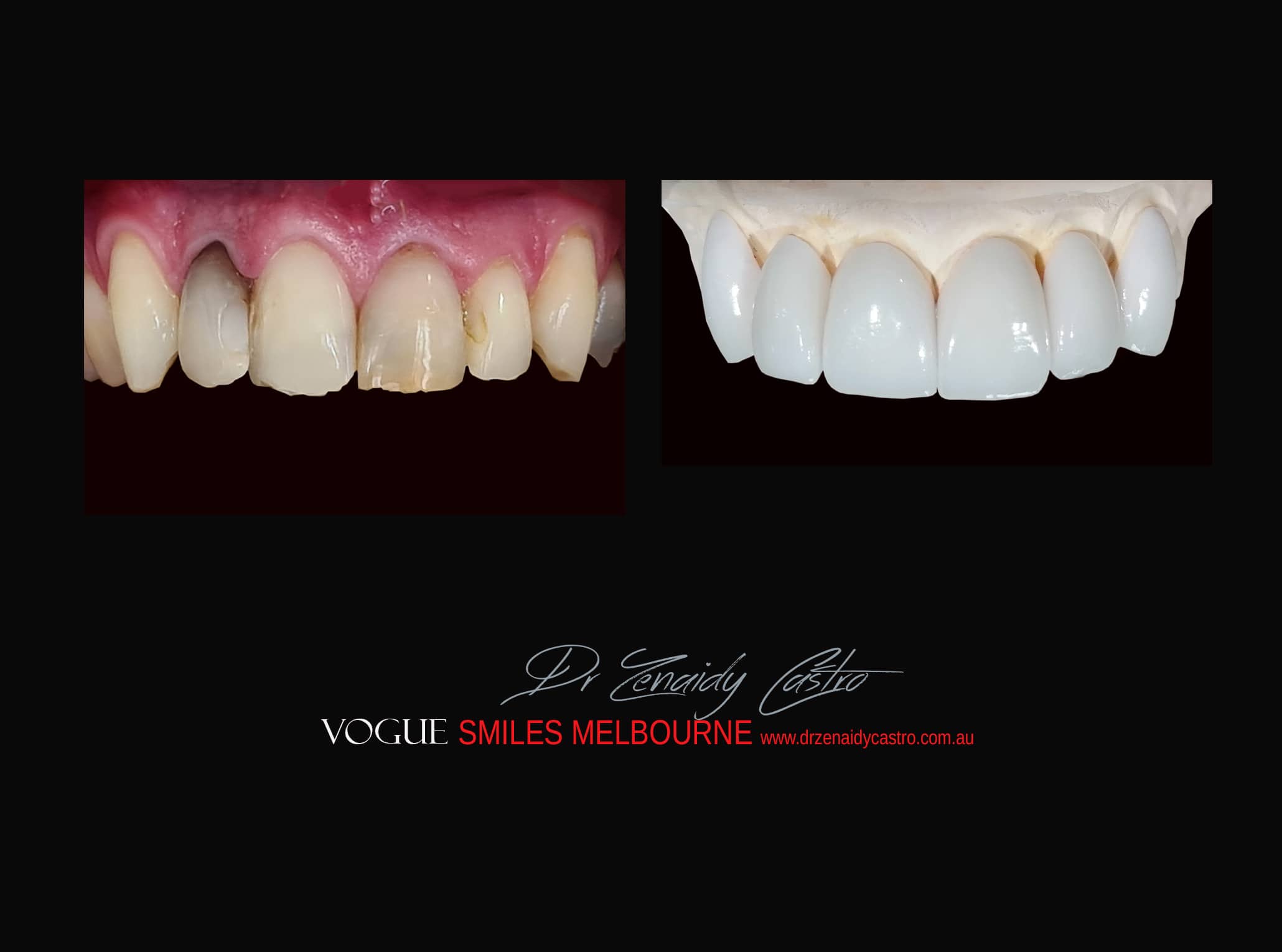 Top Cosmetic Dentist in Melbourne CBD before and after photo case study r46
