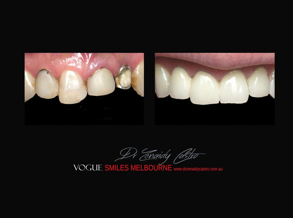 Top Cosmetic Dentist in Melbourne CBD before and after photo case study r45