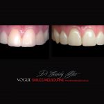 Top Cosmetic Dentist in Melbourne CBD before and after photo case study r44