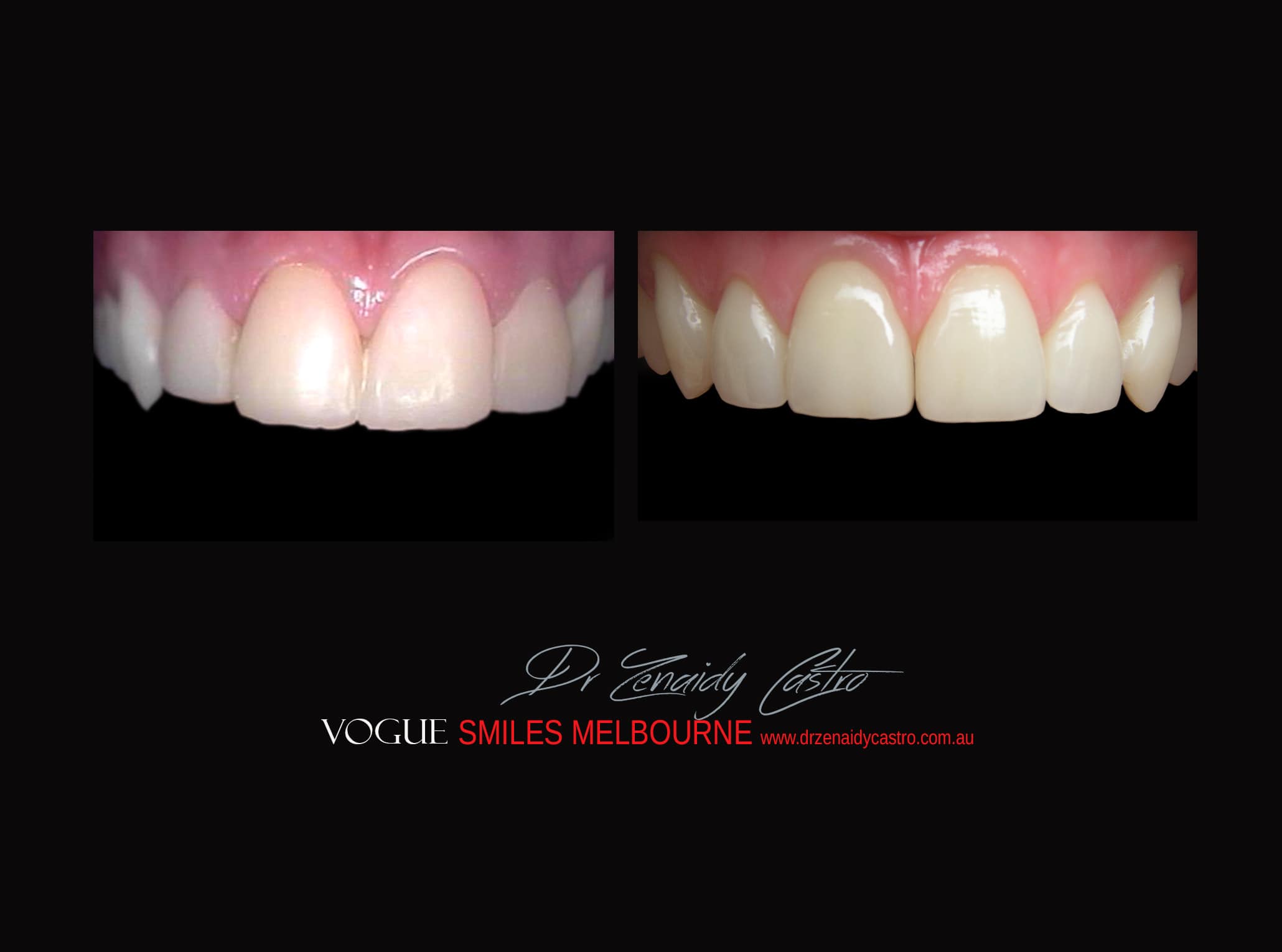 Top Cosmetic Dentist in Melbourne CBD before and after photo case study r44