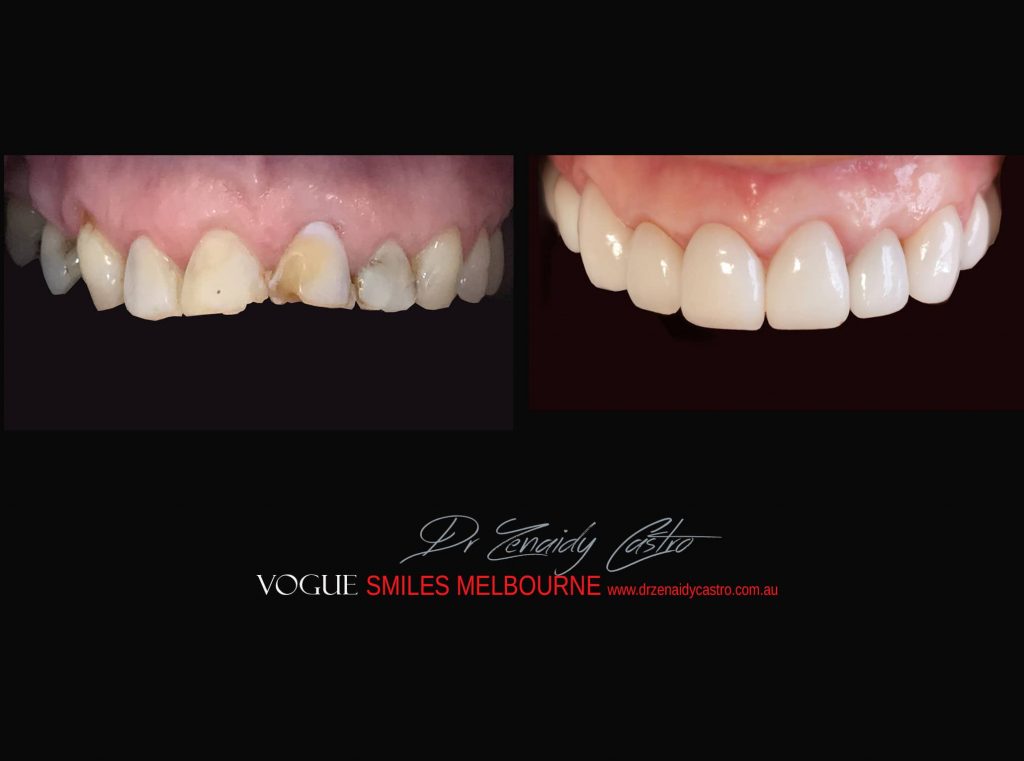 Top Cosmetic Dentist in Melbourne CBD before and after photo case study r79