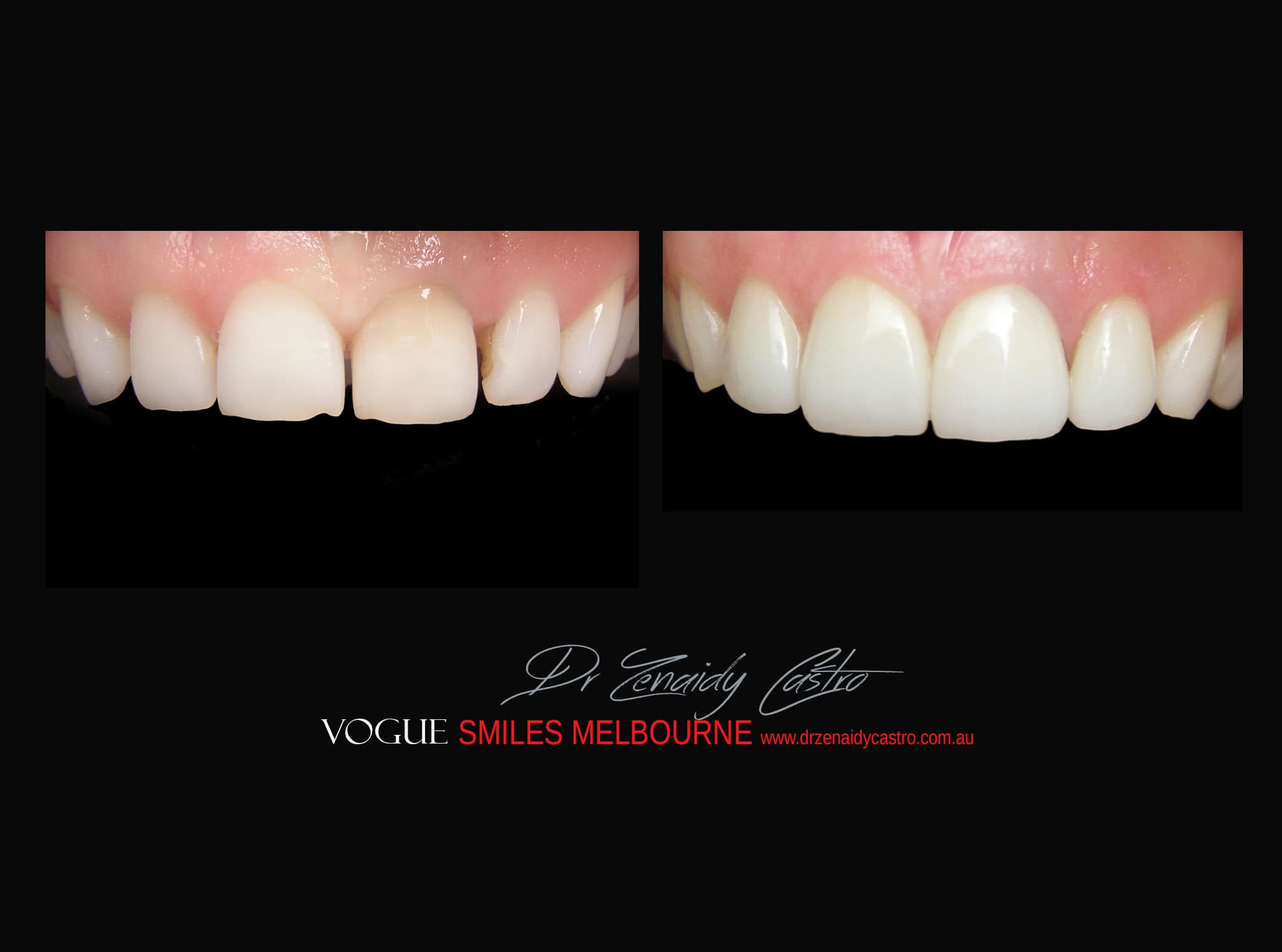 Top Cosmetic Dentist in Melbourne CBD before and after photo case study r43