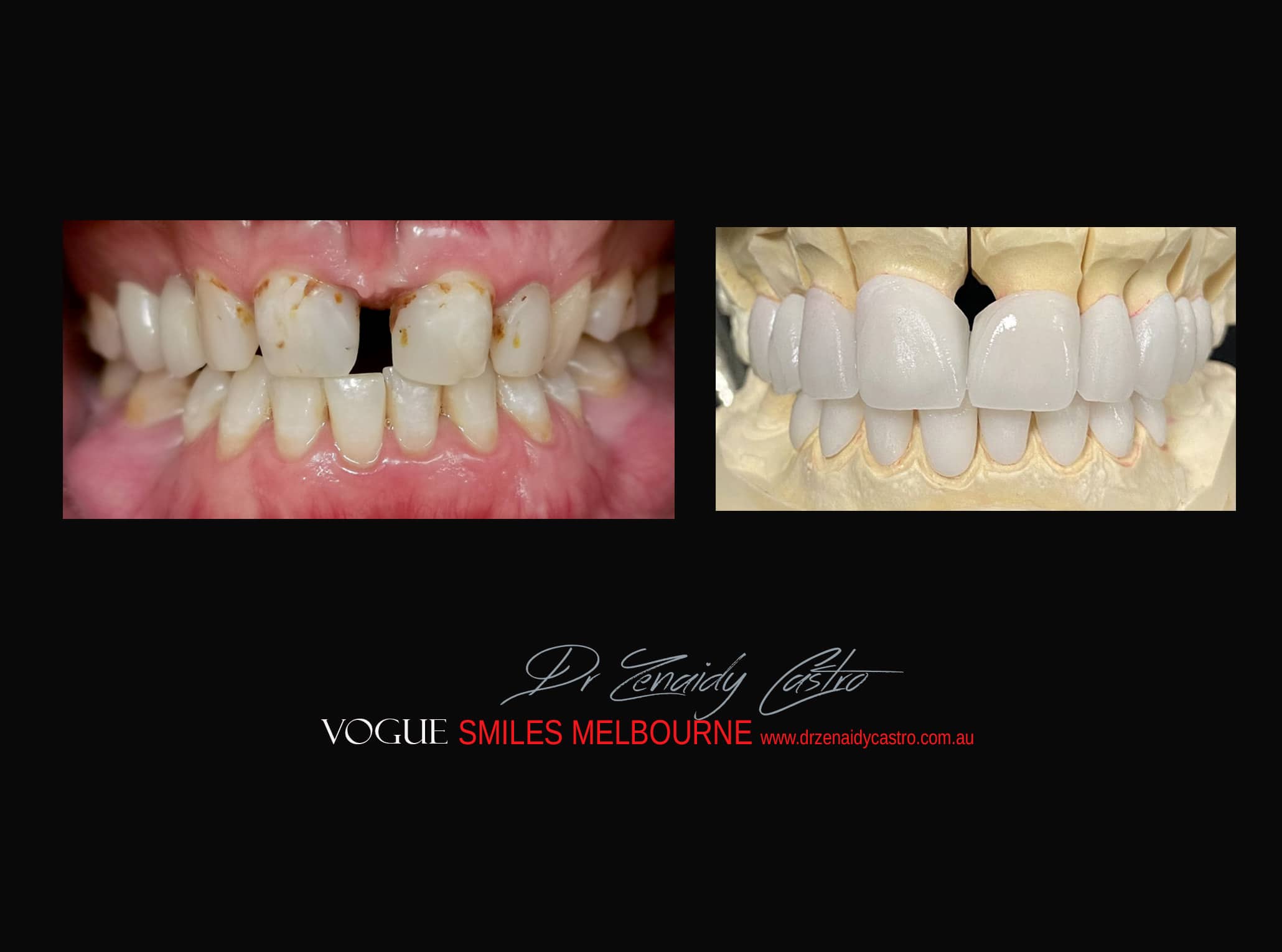 Top Cosmetic Dentist in Melbourne CBD before and after photo case study r42