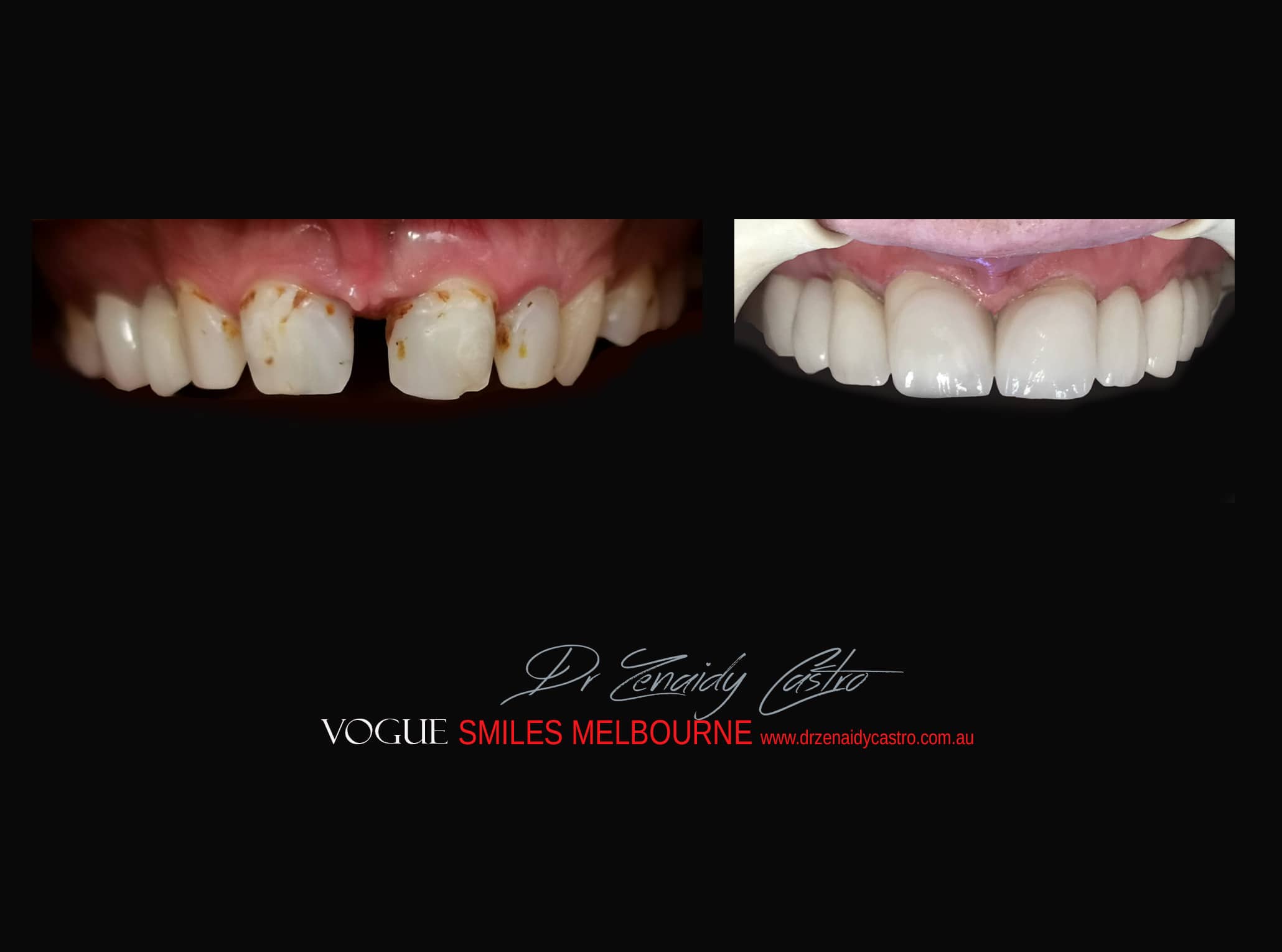 Top Cosmetic Dentist in Melbourne CBD before and after photo case study r41