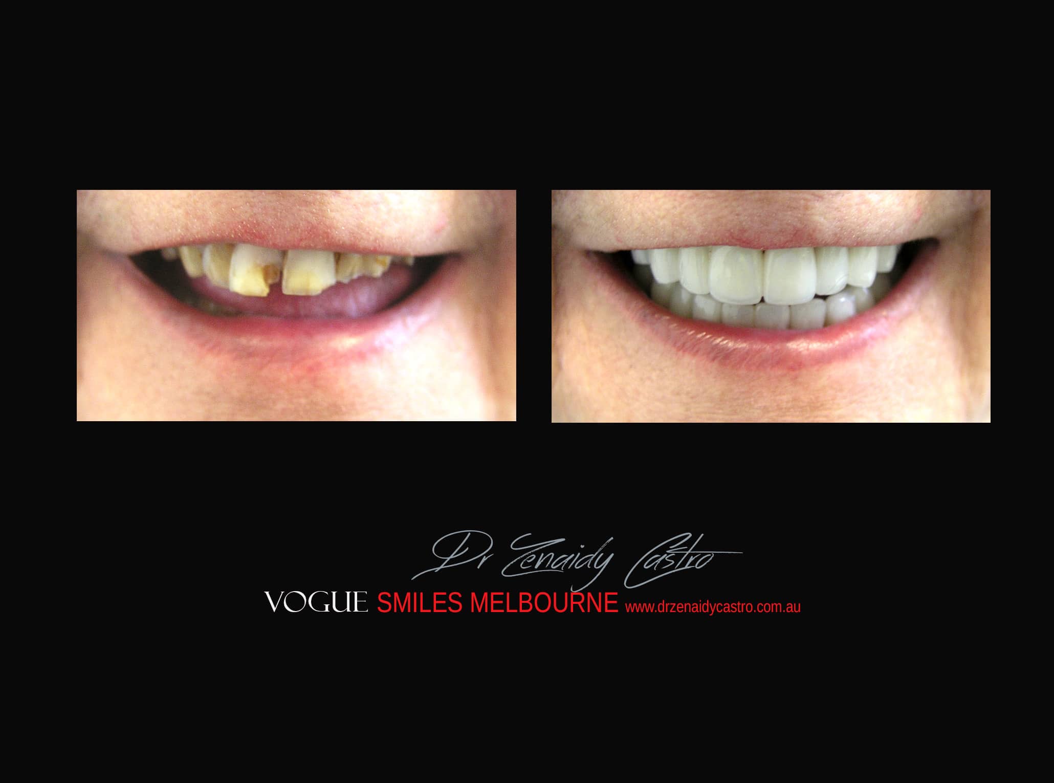 Top Cosmetic Dentist in Melbourne CBD before and after photo case study r40