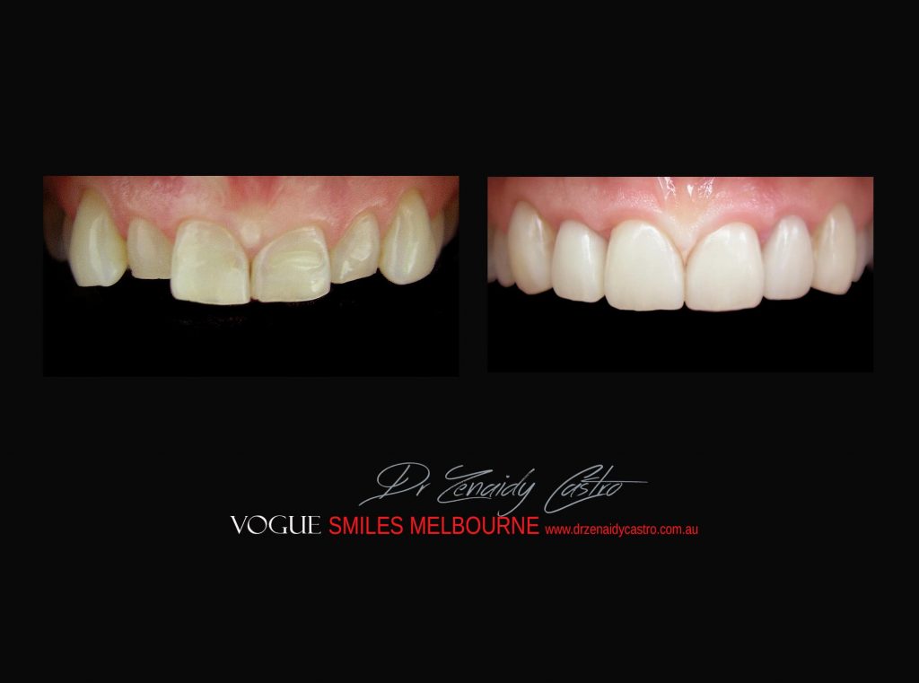 Top Cosmetic Dentist in Melbourne CBD before and after photo case study r39