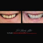 COSMETIC DENTIST MELBOURNE CASE STUDIES OF BEFORE AND AFTER- Top Cosmetic Dentist in Melbourne