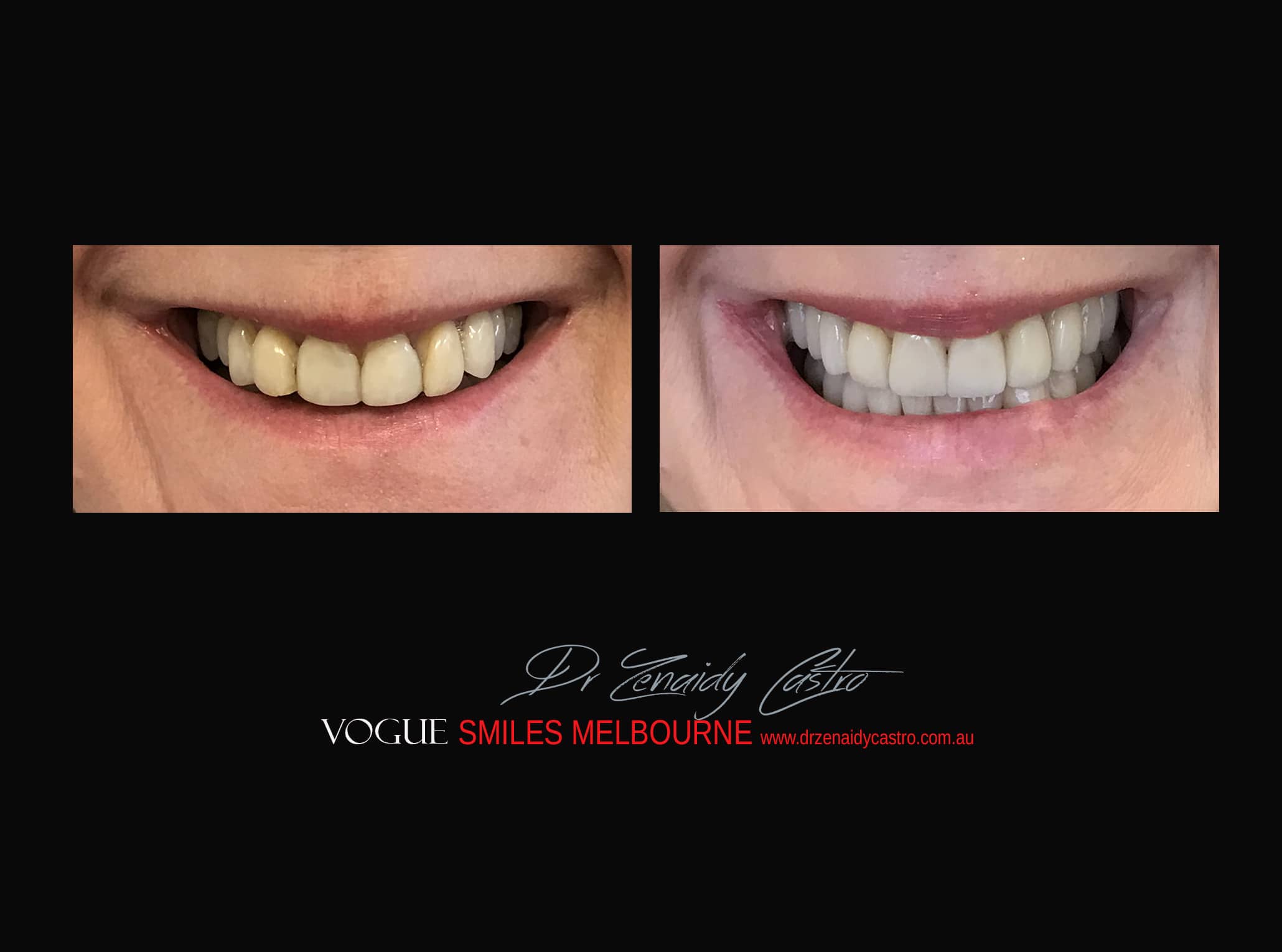 Top Cosmetic Dentist in Melbourne CBD before and after photo case study r38