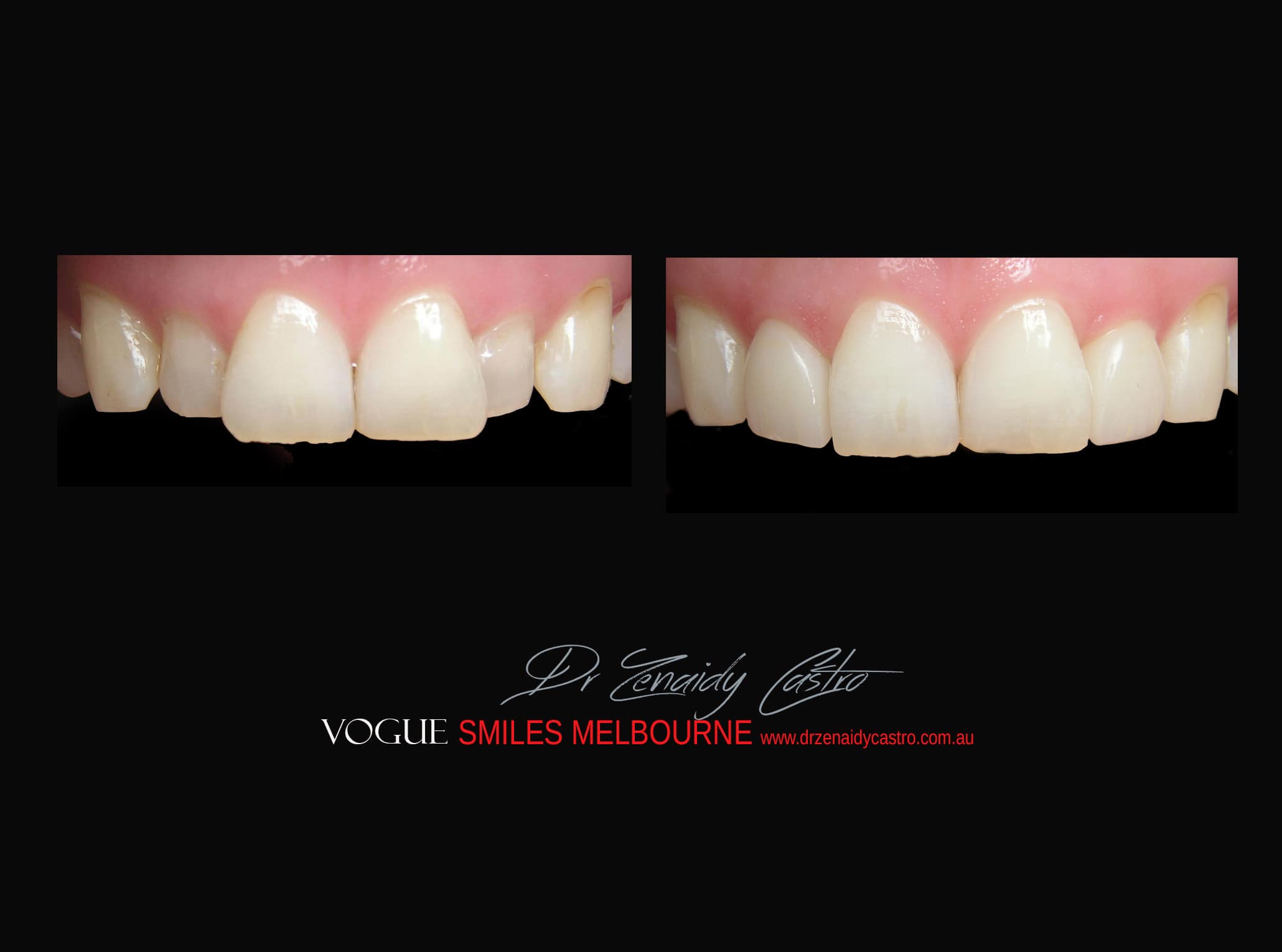 Top Cosmetic Dentist in Melbourne CBD before and after photo case study r37
