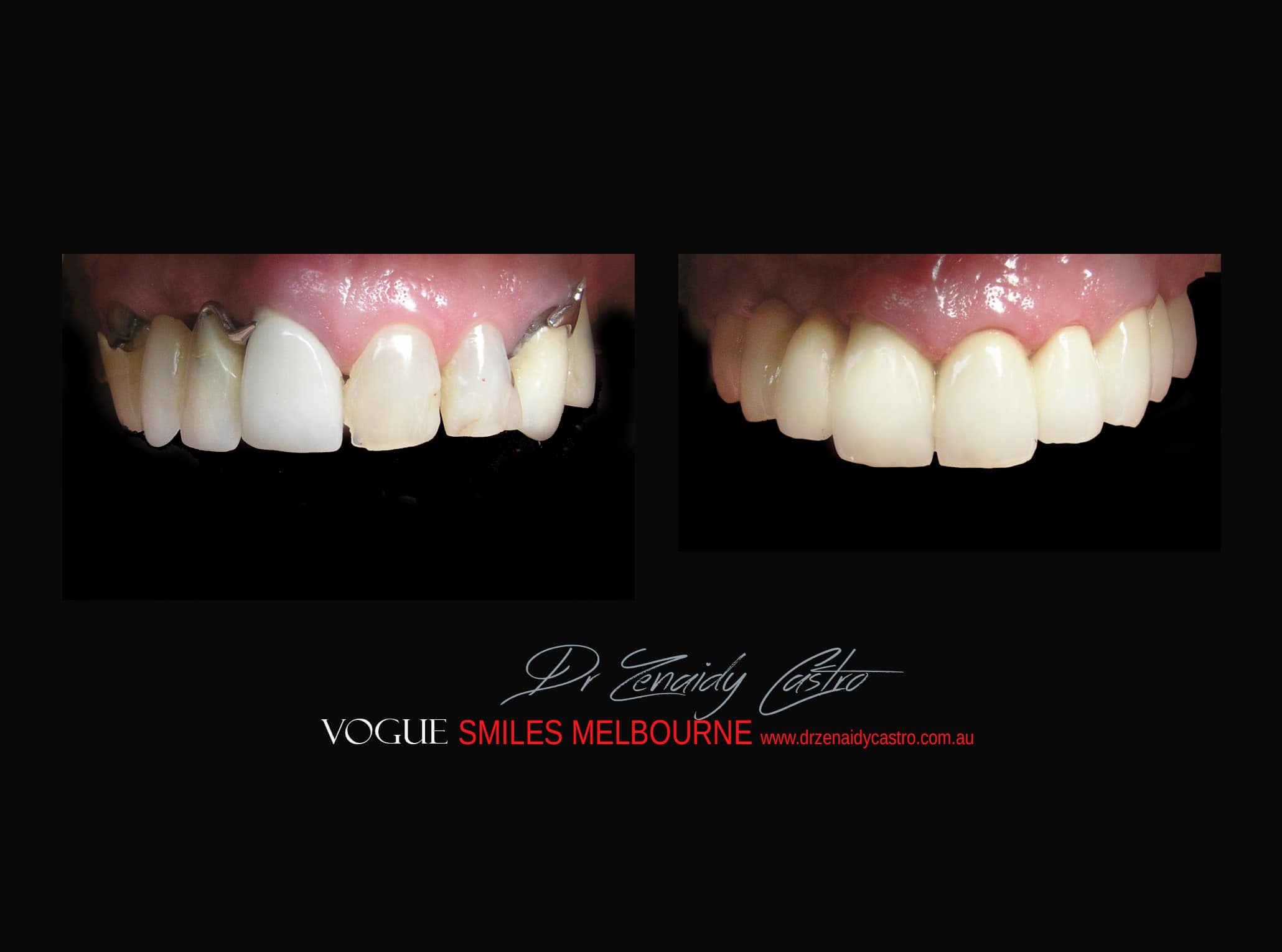 Top Cosmetic Dentist in Melbourne CBD before and after photo case study r36