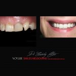 Top Cosmetic Dentist in Melbourne CBD before and after photo case study r35