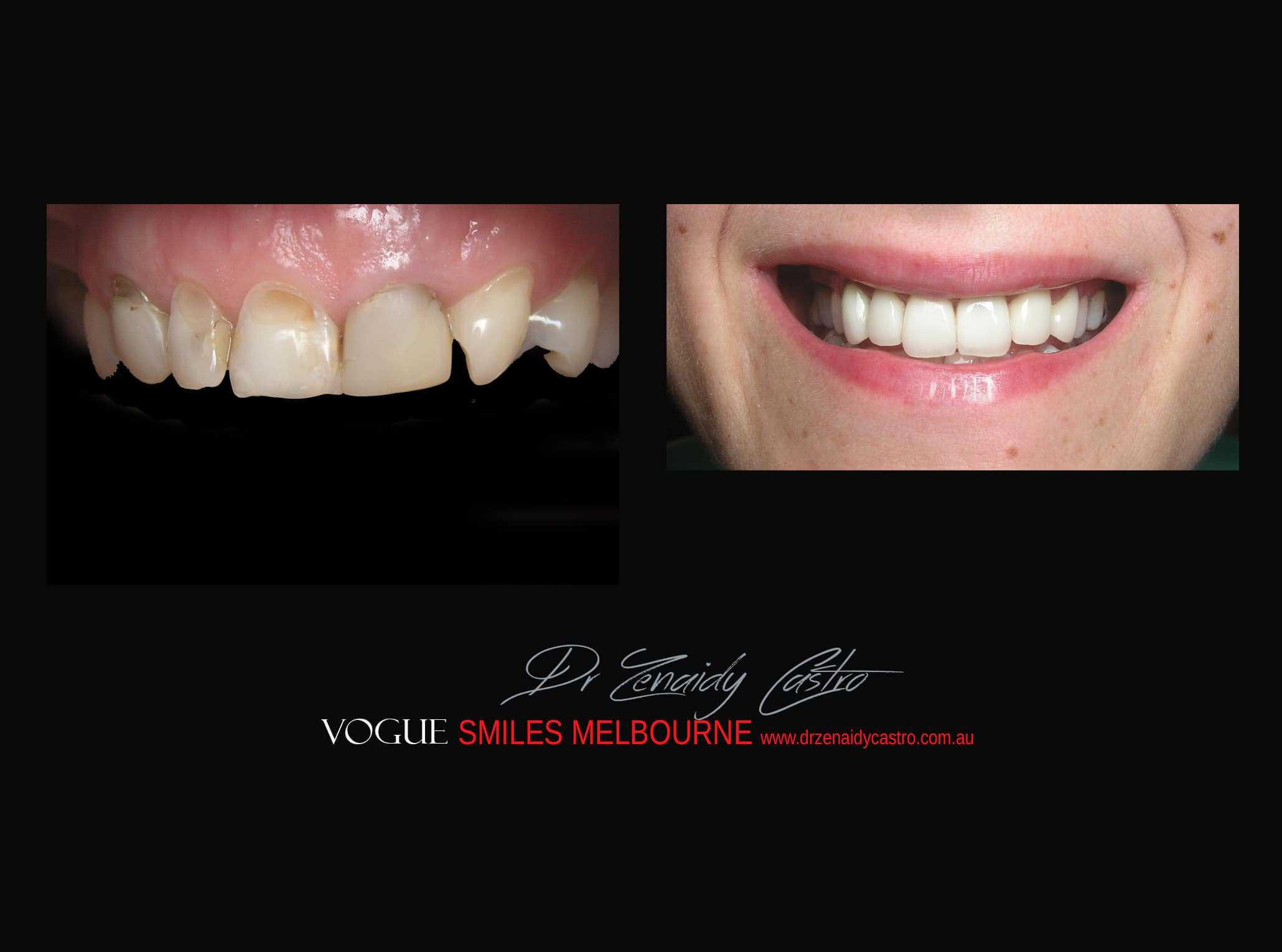 Top Cosmetic Dentist in Melbourne CBD before and after photo case study r35