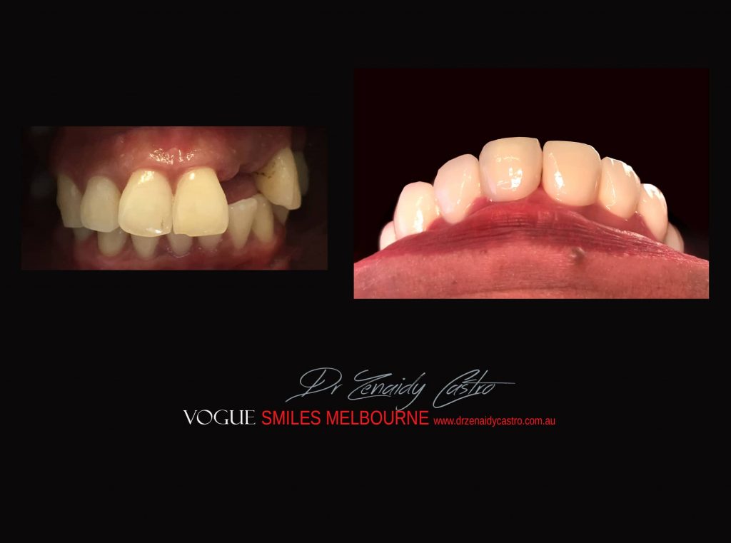 COSMETIC DENTIST MELBOURNE CASE STUDIES OF BEFORE AND AFTER- Top Cosmetic Dentist in Melbourne