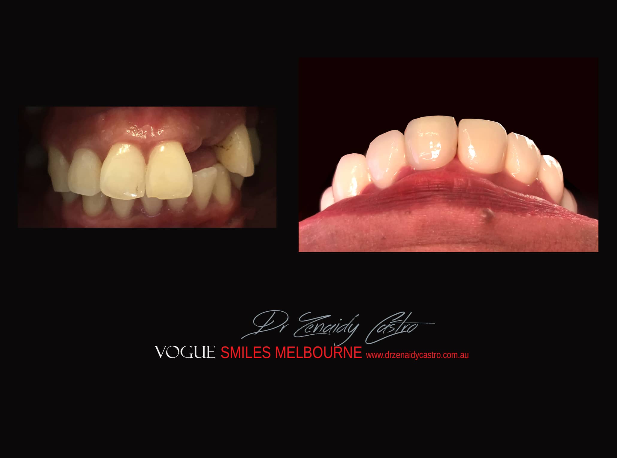 Top Cosmetic Dentist in Melbourne CBD before and after photo case study r34
