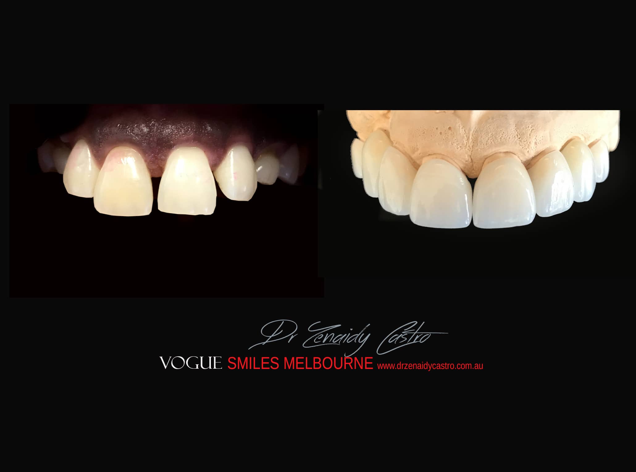 Top Cosmetic Dentist in Melbourne CBD before and after photo case study r78